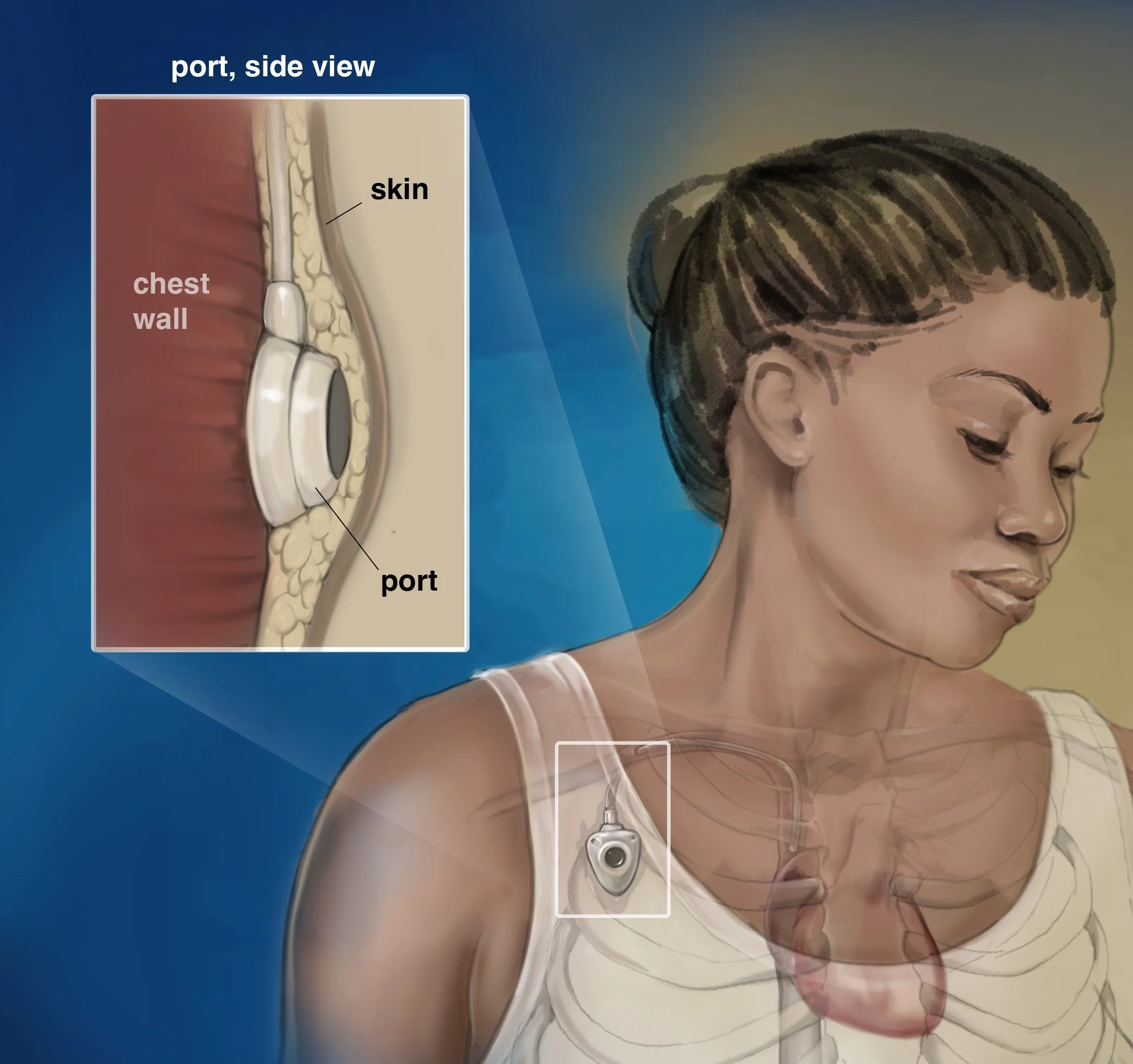 Implanted Port (Port-a-Cath)