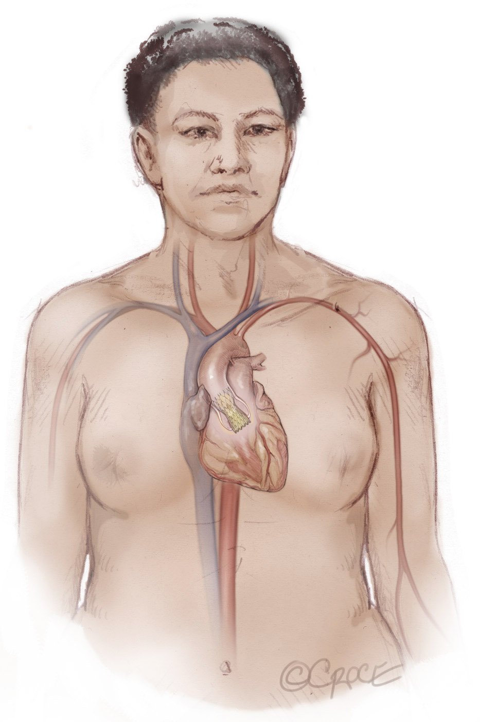 TAVI (Transcatheter Aortic Valve Implantation)