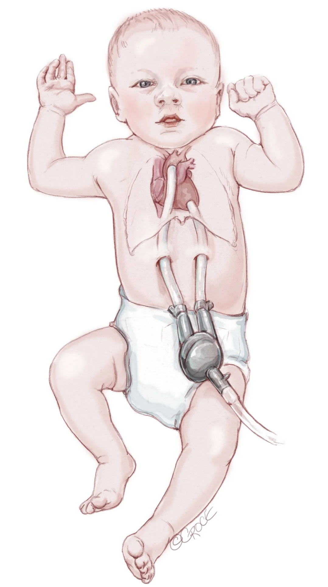 05 Infant LVAD.jpg