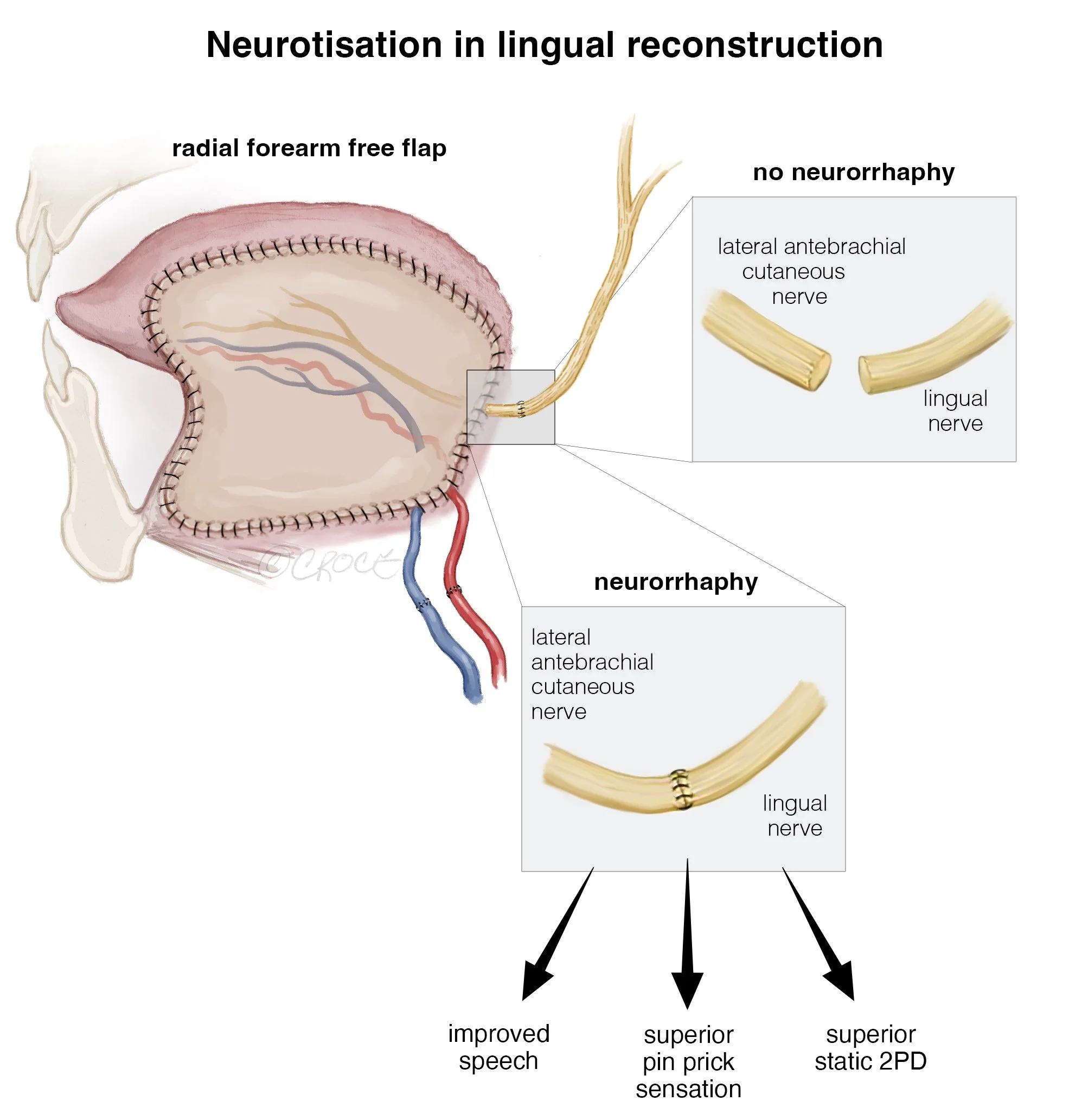 Neurotisation.jpg