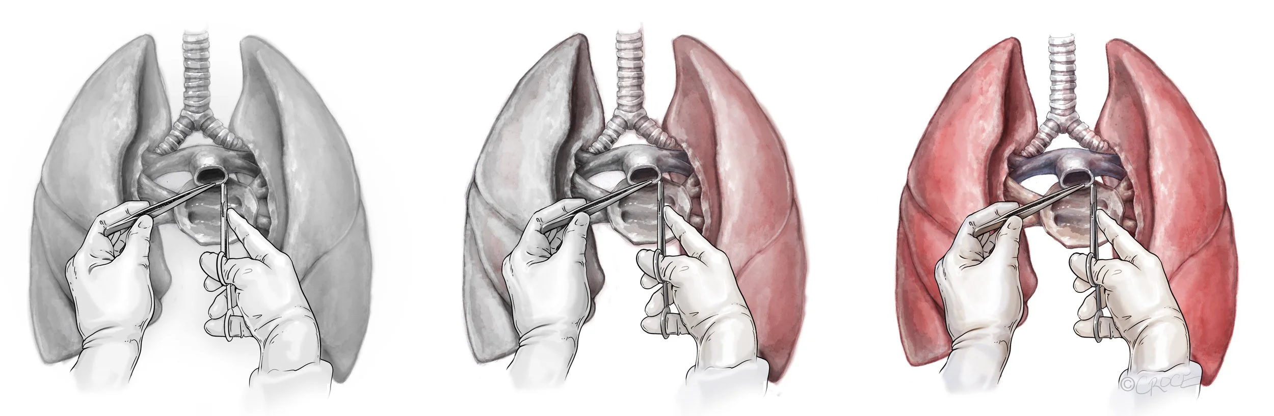lung_transplant1.jpg