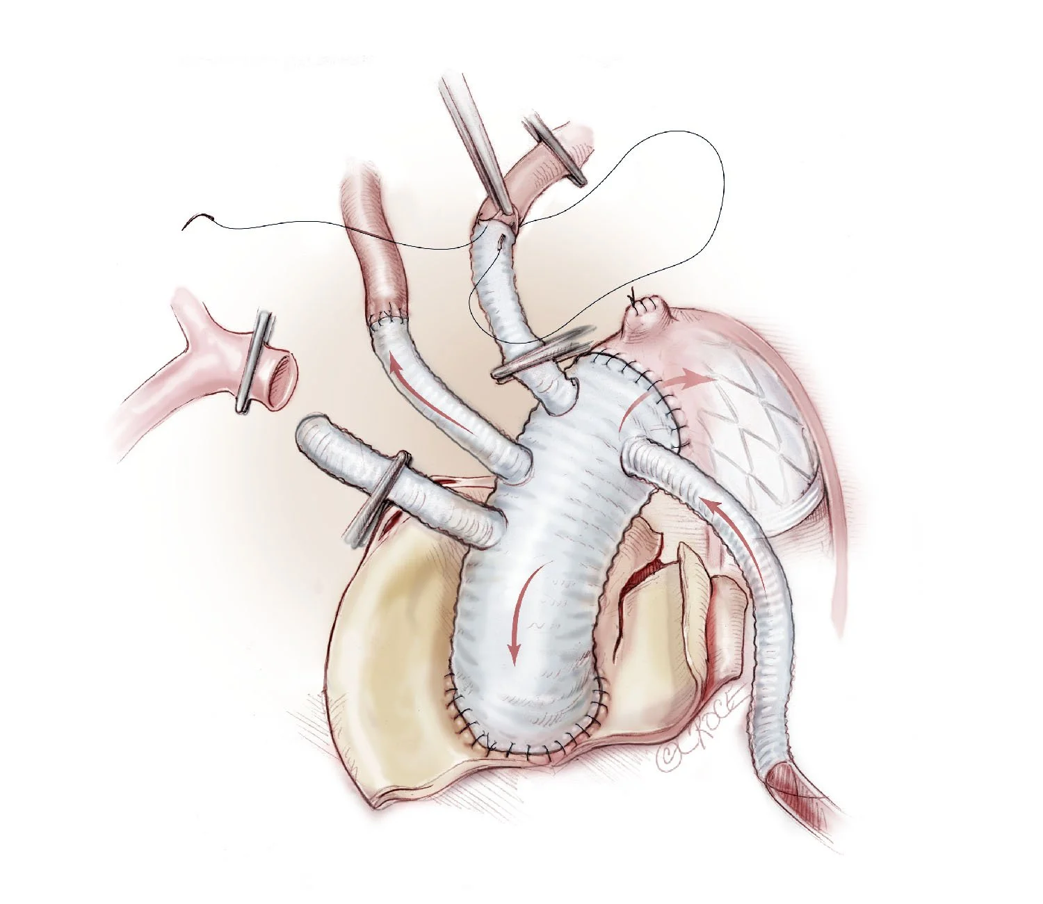 Branch First Aortic Graft