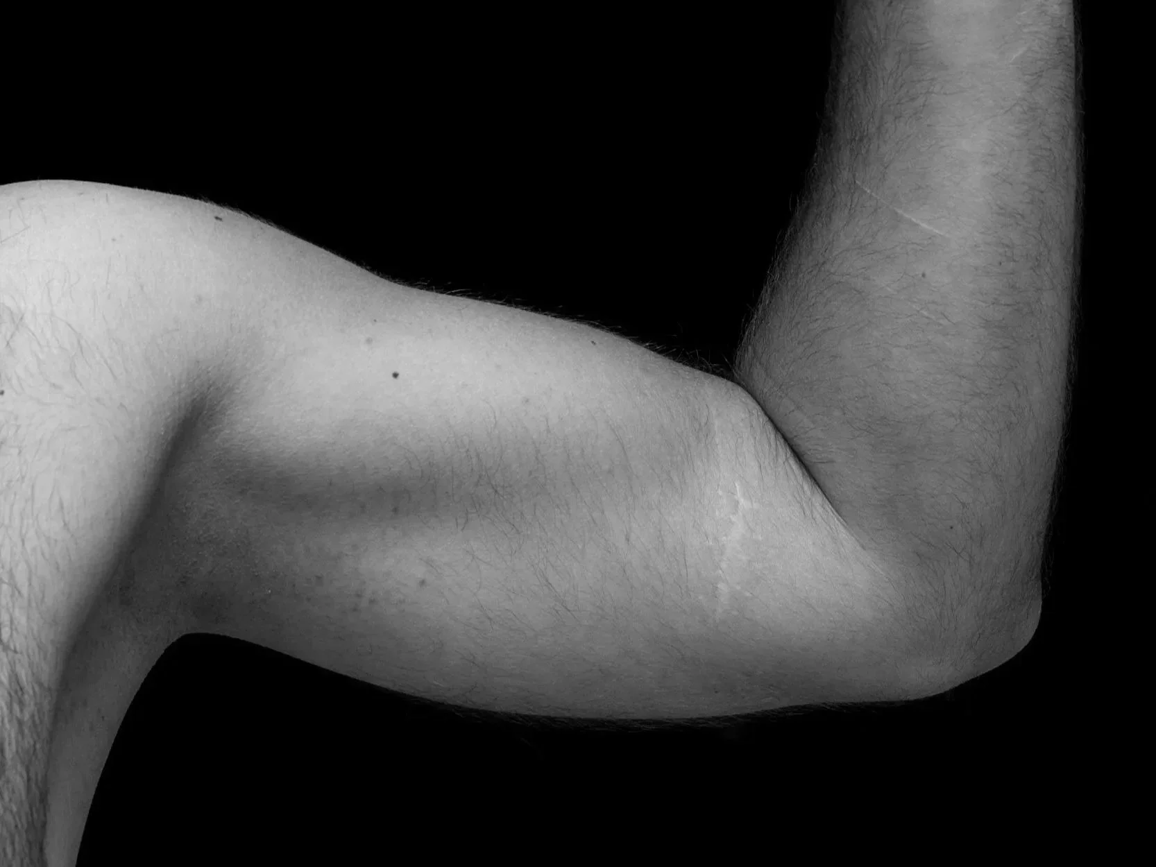 Black and white photograph of a person's arm. Joint treatment by dr. Missaghi