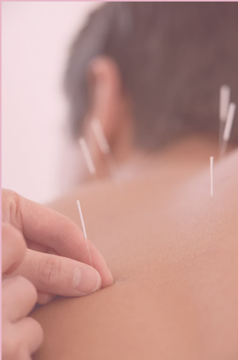 Dry Needling