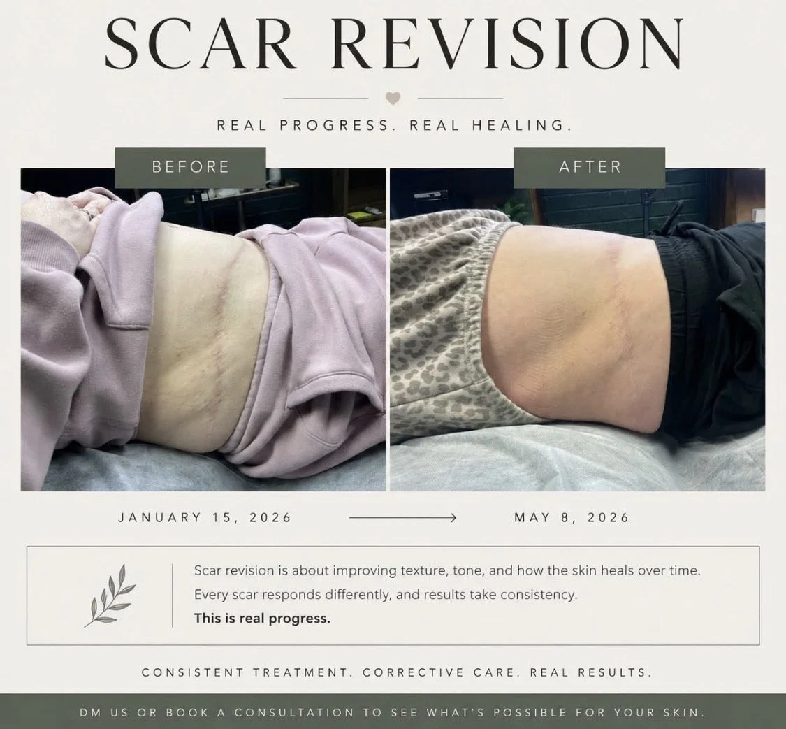 Lipo Laser — $150 per session