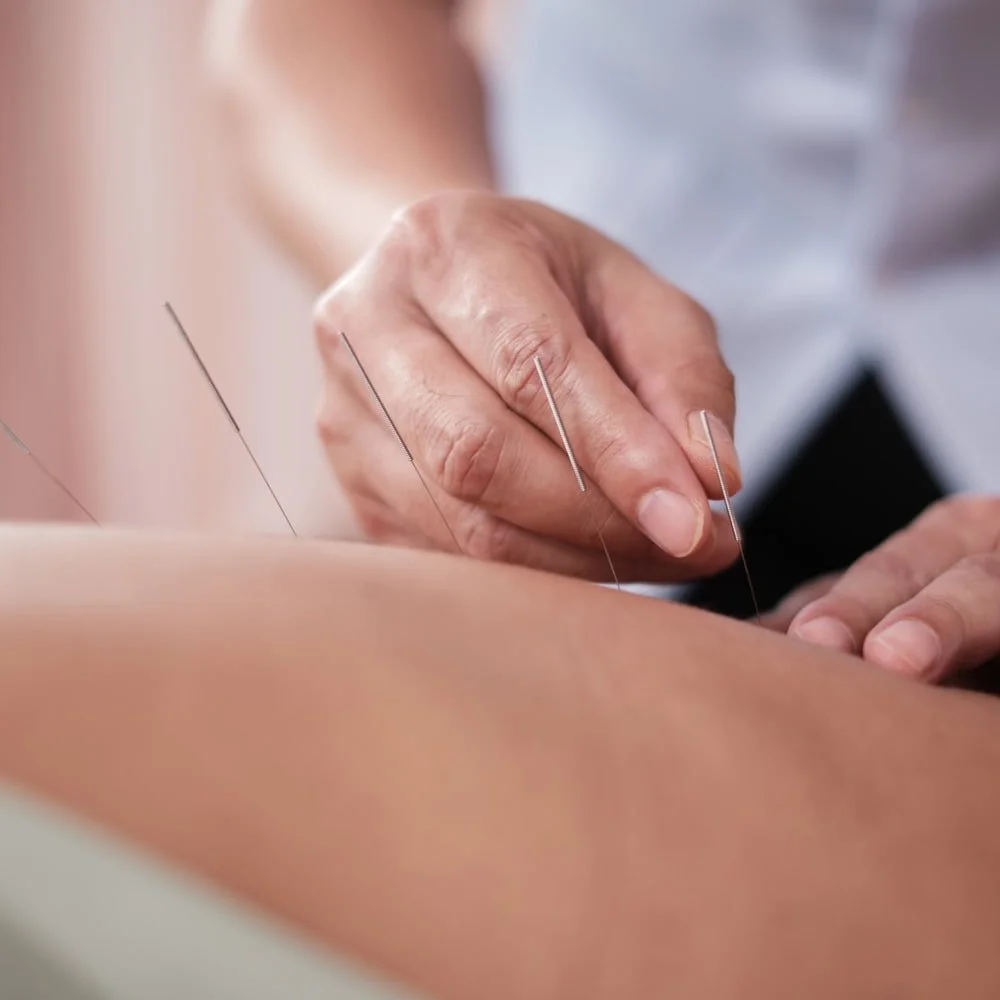 Practitioner's hands placing acupuncture needles.