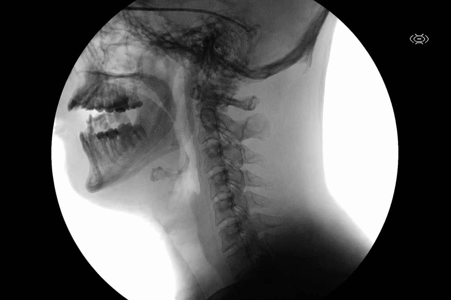 Lateral X-ray of a human skull and neck showing teeth, jaw, and cervical spine.