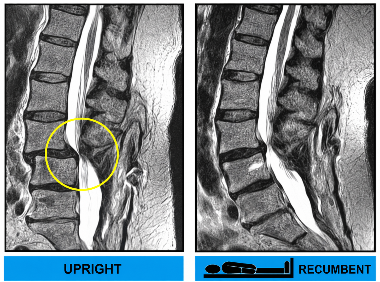 Side-by-side MRI images of the lumbar spine showing an upright position on the left and a recumbent position on the right, with the upright image highlighted by a yellow circle.