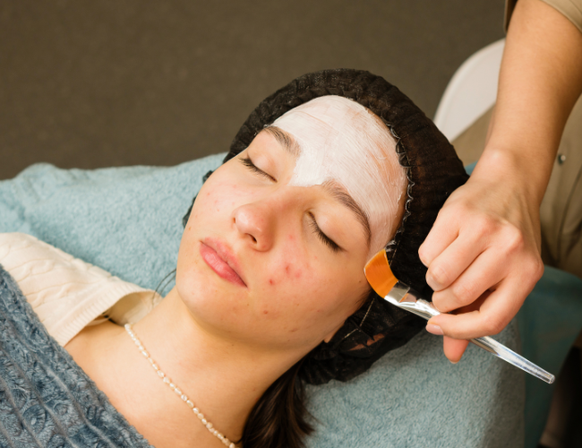 Young woman with acne getting a facial treatment, lying with a headband and a white facial mask applied, as a professional uses a brush to apply skincare products.