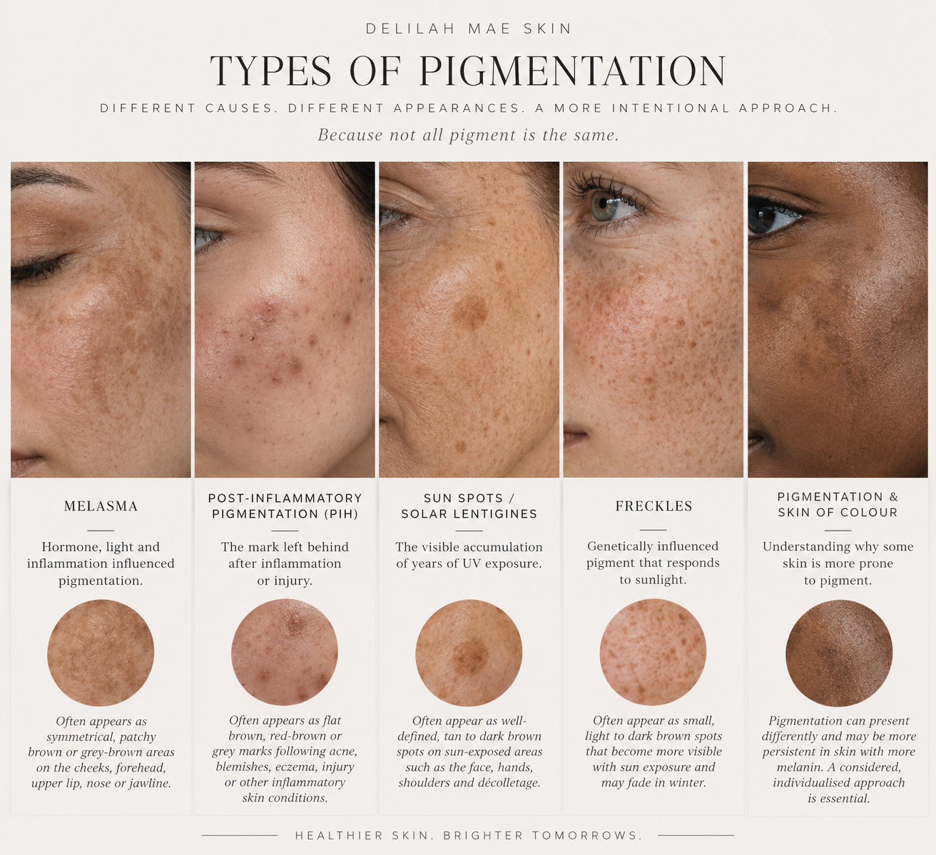 Why Does Pigmentation Keep Coming Back?