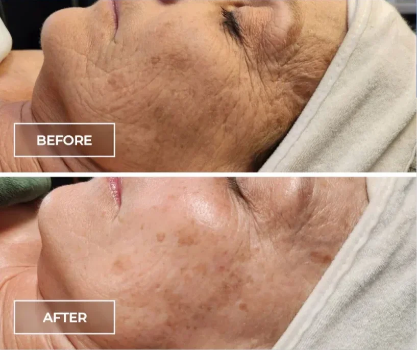 Comparison of facial skin before and after treatment; the before image shows dry, wrinkled skin with uneven texture, while the after image shows smoother, clearer skin with less visible wrinkles and pigmentation.