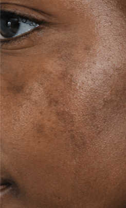 Pigmentation and Skin of Colour
