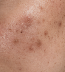 Post Inflammatory Pigmentation