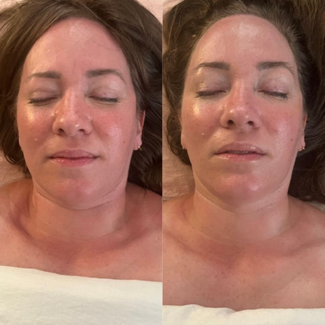 Side-by-side comparison of a woman with closed eyes, showing her face before and after a skincare or cosmetic treatment.