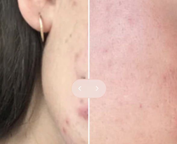 Close-up of a person's face showing a before and after comparison of skin with acne and clear skin.