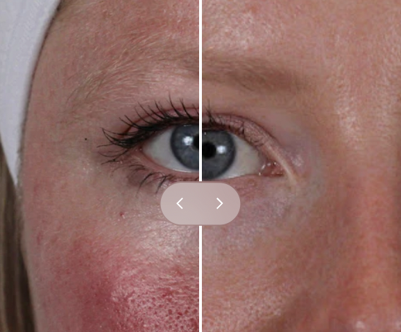 Close-up of a woman's face split in half, showing one side with clear, smooth skin and the other side with redness, irritation, and uneven skin texture.