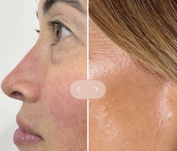Side-by-side comparison of a woman's face showing before and after skin treatment, highlighting improvements in skin texture and complexion.