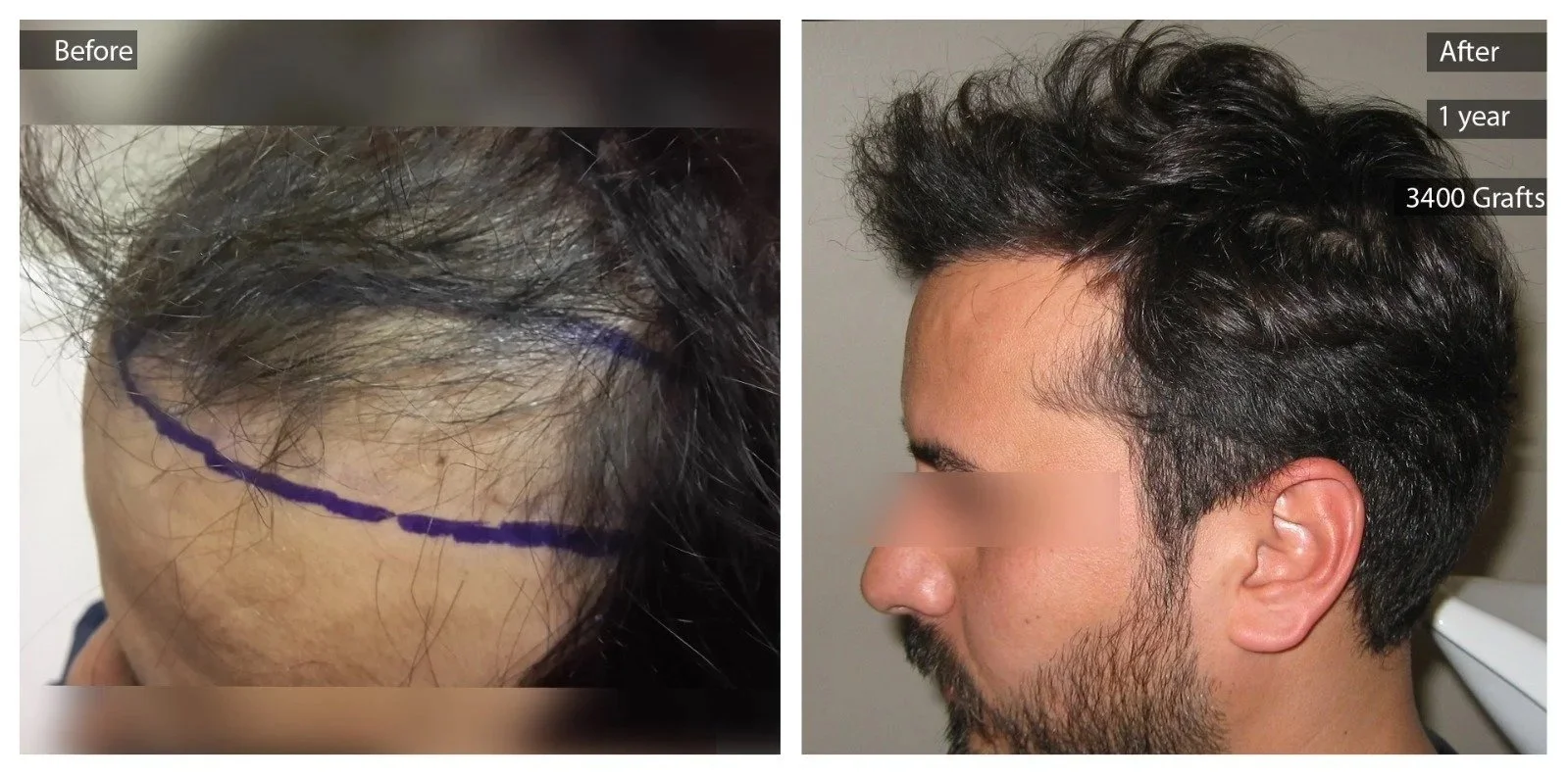 Side-by-side comparison of a man's hair before and after hair transplant. The left shows thinning hair with a marked hairline, and the right shows thicker, fuller hair with 3,400 grafts after one year.