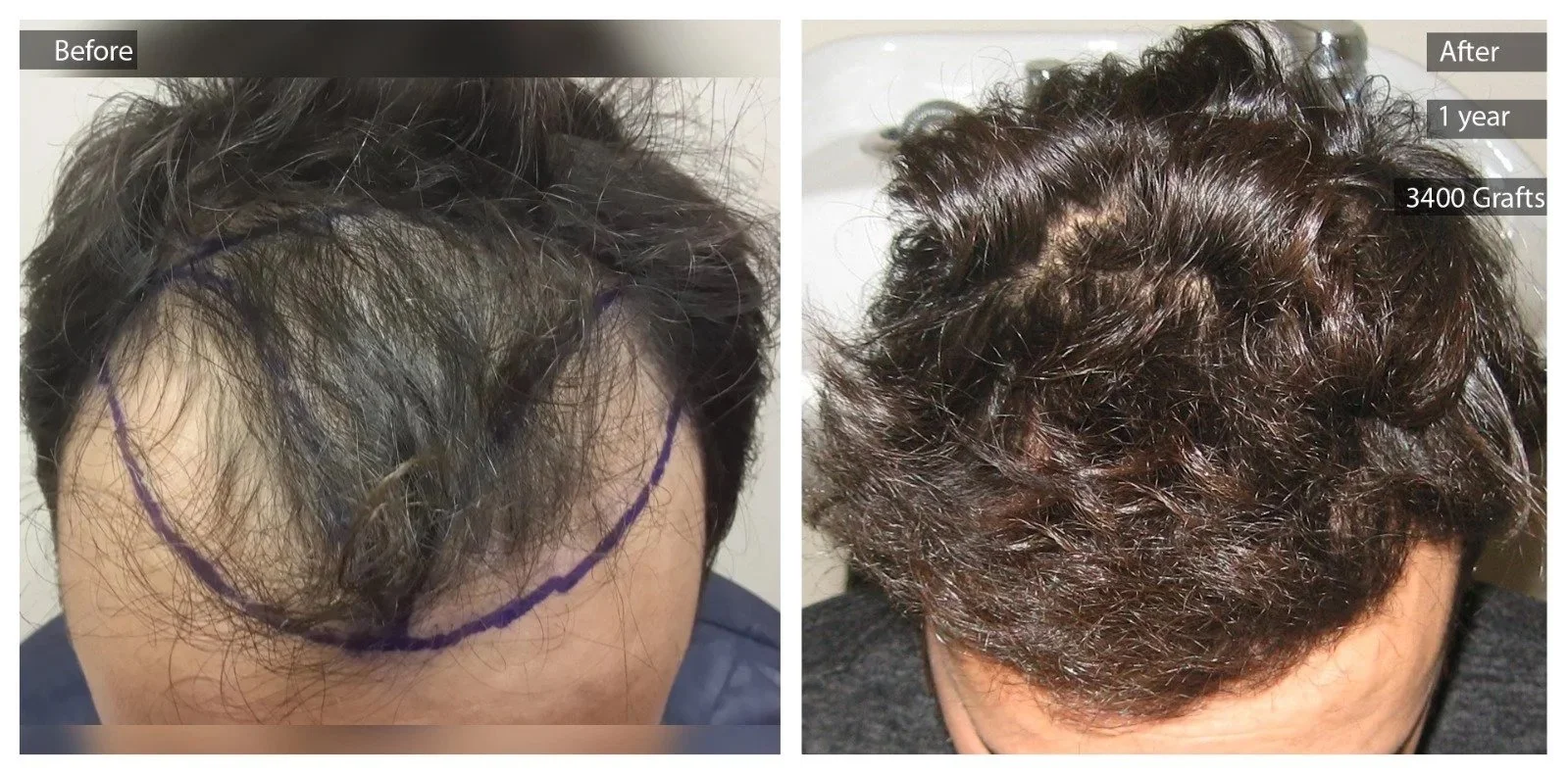 Side-by-side comparison of a person's scalp before and after hair transplant. The left shows thinning hair with purple markings and the right shows a full head of curly, dark hair after 1 year and 3400 grafts.