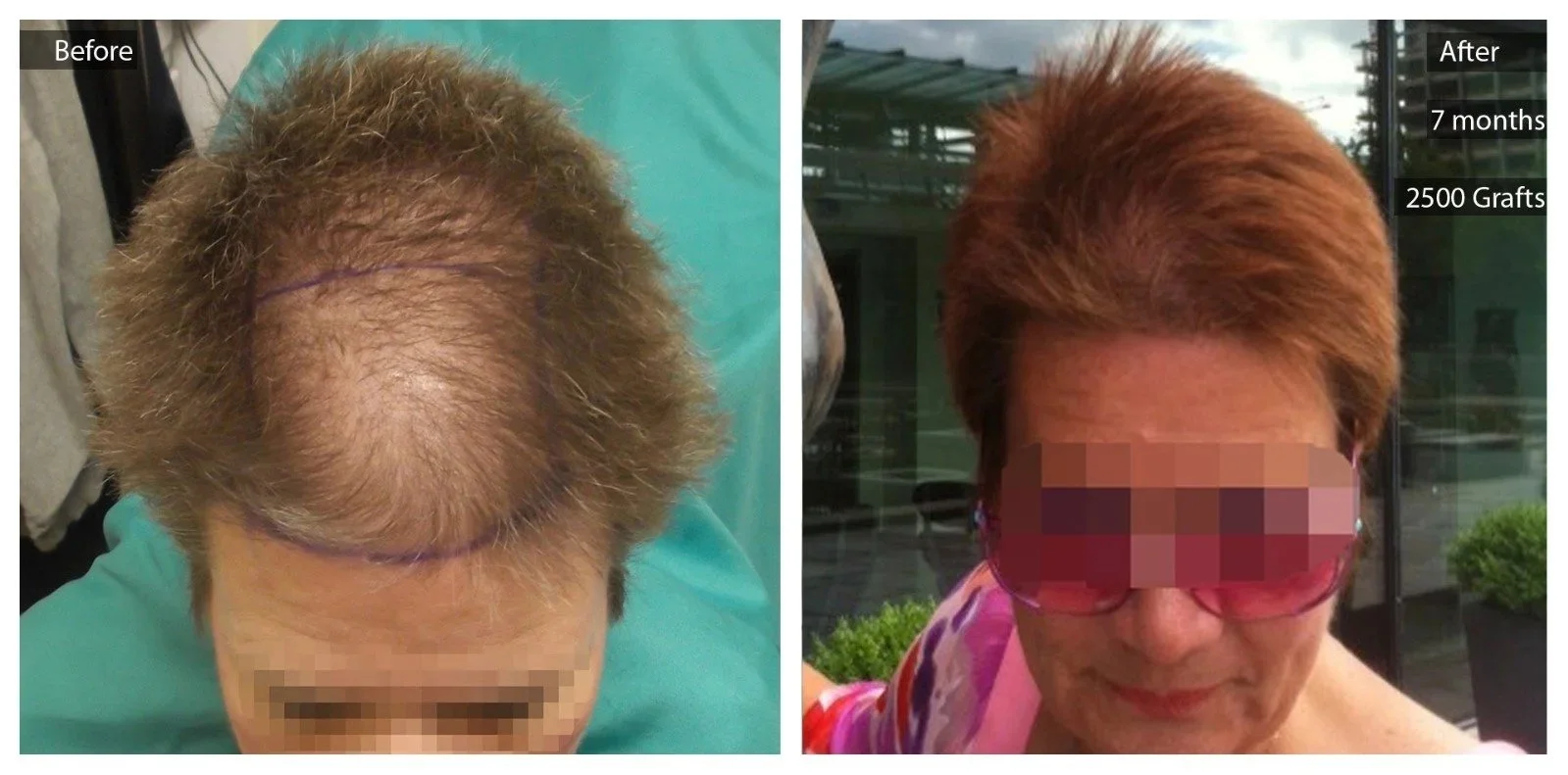 Comparison of a woman's hair before and after hair transplant; left side shows thinning hair with a purple line marking the area, right side shows fuller, styled hair with overlay text indicating '7 months', '2500 Grafts'.