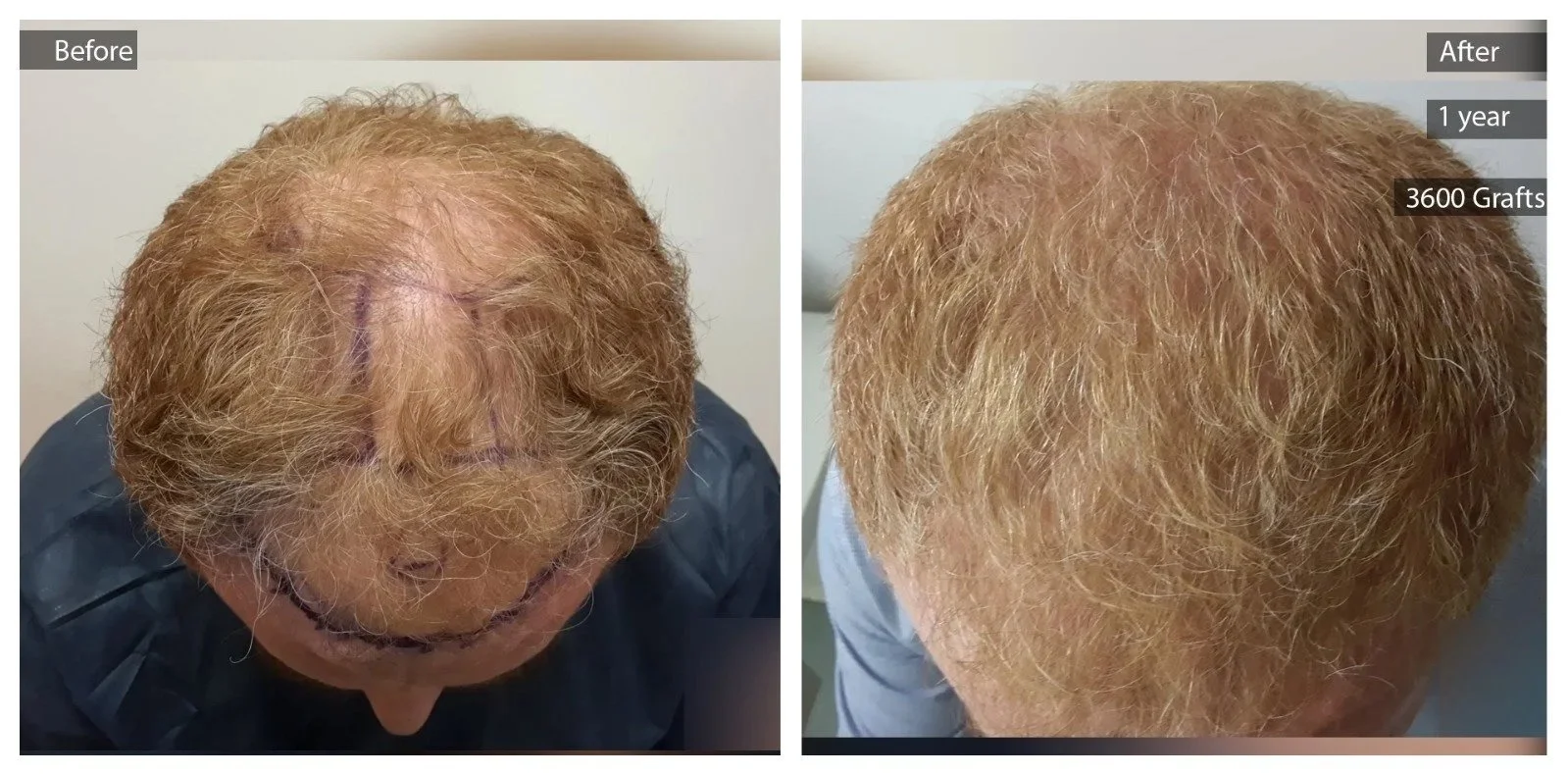 Comparison of a man's scalp before and after hair restoration, showing significant hair growth and density increase after 1 year with 3600 grafts.