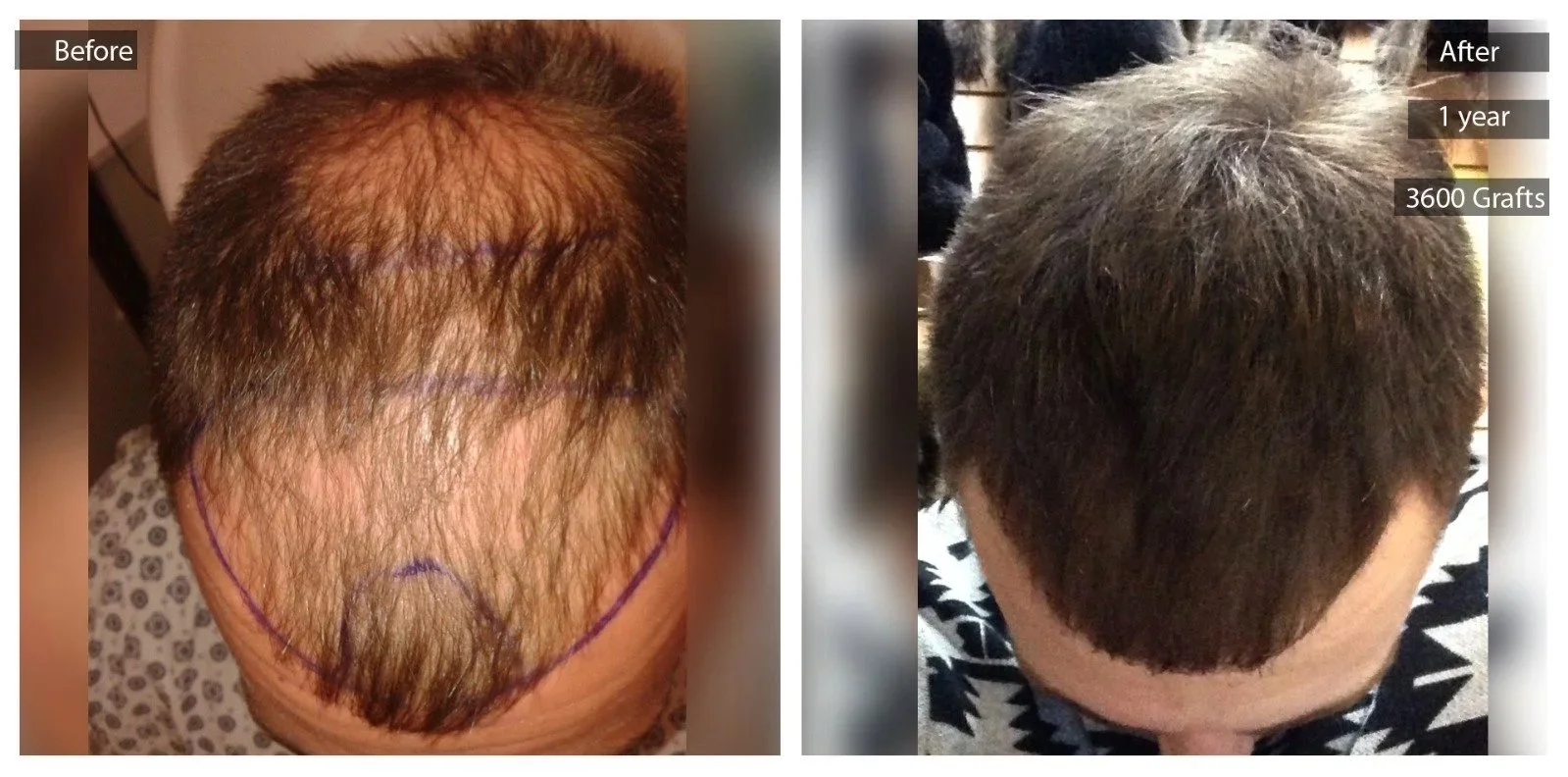 Side-by-side comparison of a man's scalp before and after hair transplant. The left shows thinning hair with marked outline, the right shows a fuller scalp after one year with 3600 grafts.
