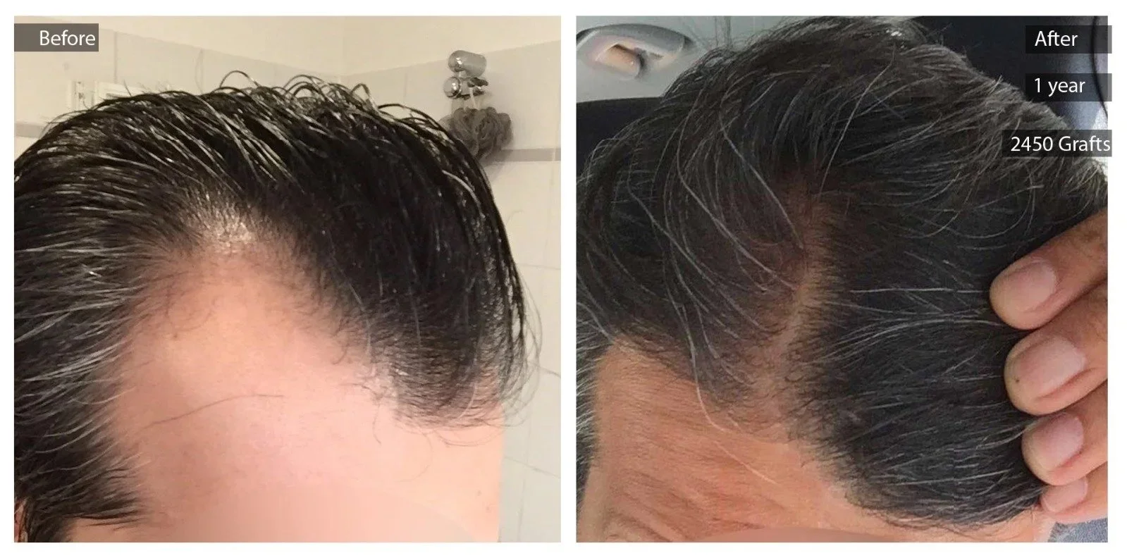 Comparison of hair before and after treatment showing increased hair density and coverage, with the right side indicating one year after 2450 grafts transplant.