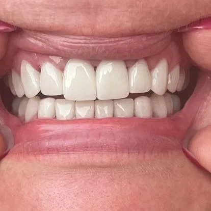 Close-up of a person smiling showing their upper and lower teeth.