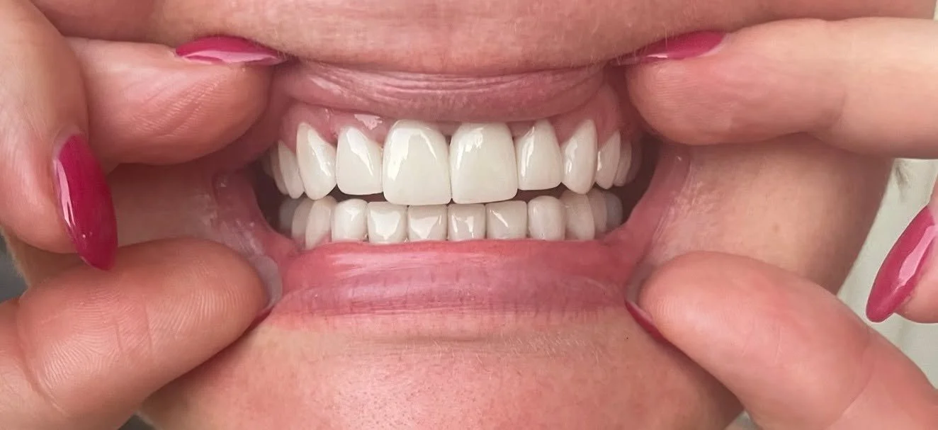 Close-up of a person smiling while holding their lips apart with fingers, showing white teeth and gums.