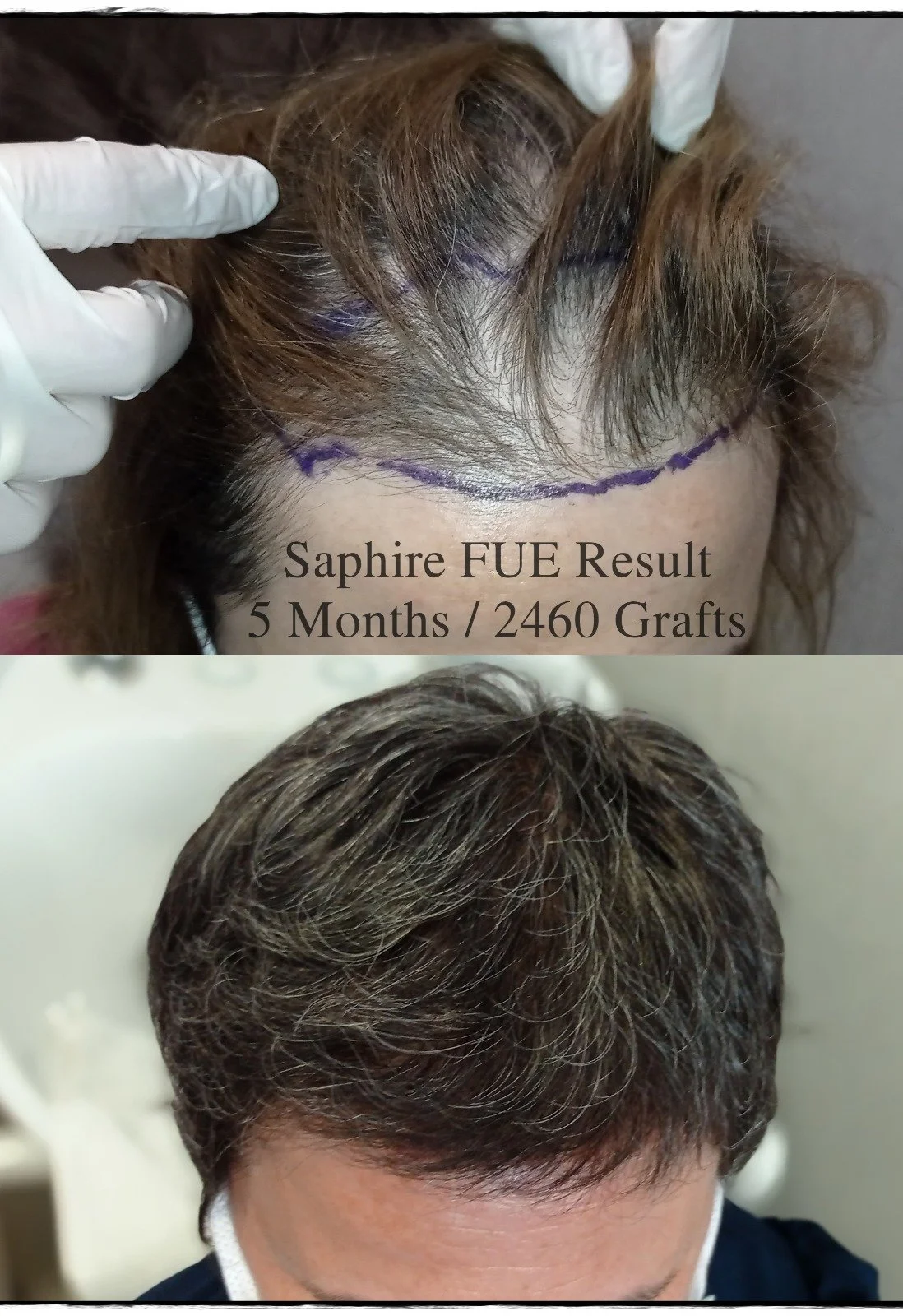 Before and after images of a person's hairline showing hair restoration results five months after 2460 grafts, with the top image displaying the hairline marked for graft placement and the bottom image showing fuller hair.