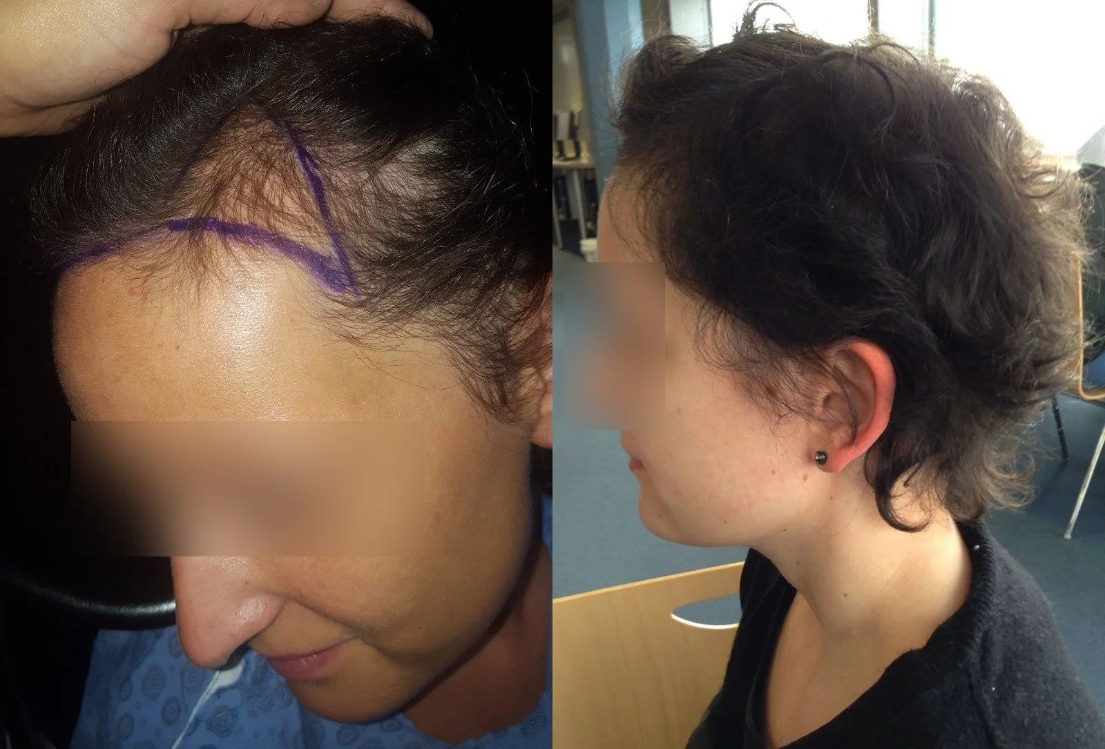 Side-by-side comparison of a woman before and after a hair transplant. In the left photo, she has thinning hair with markings on her scalp, and in the right, she has fuller, thicker hair.