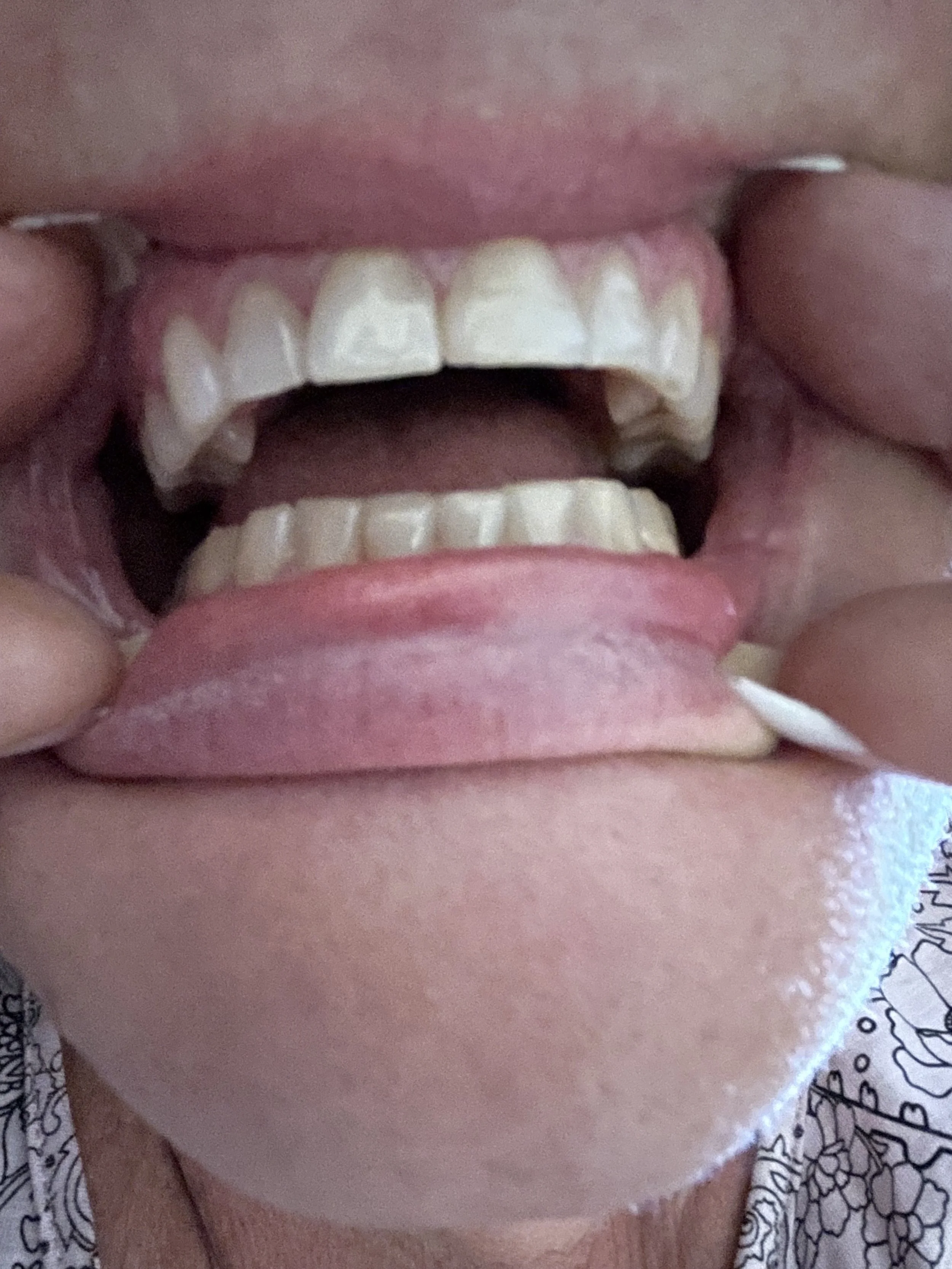 Close-up of a person's mouth with chipped and uneven teeth.