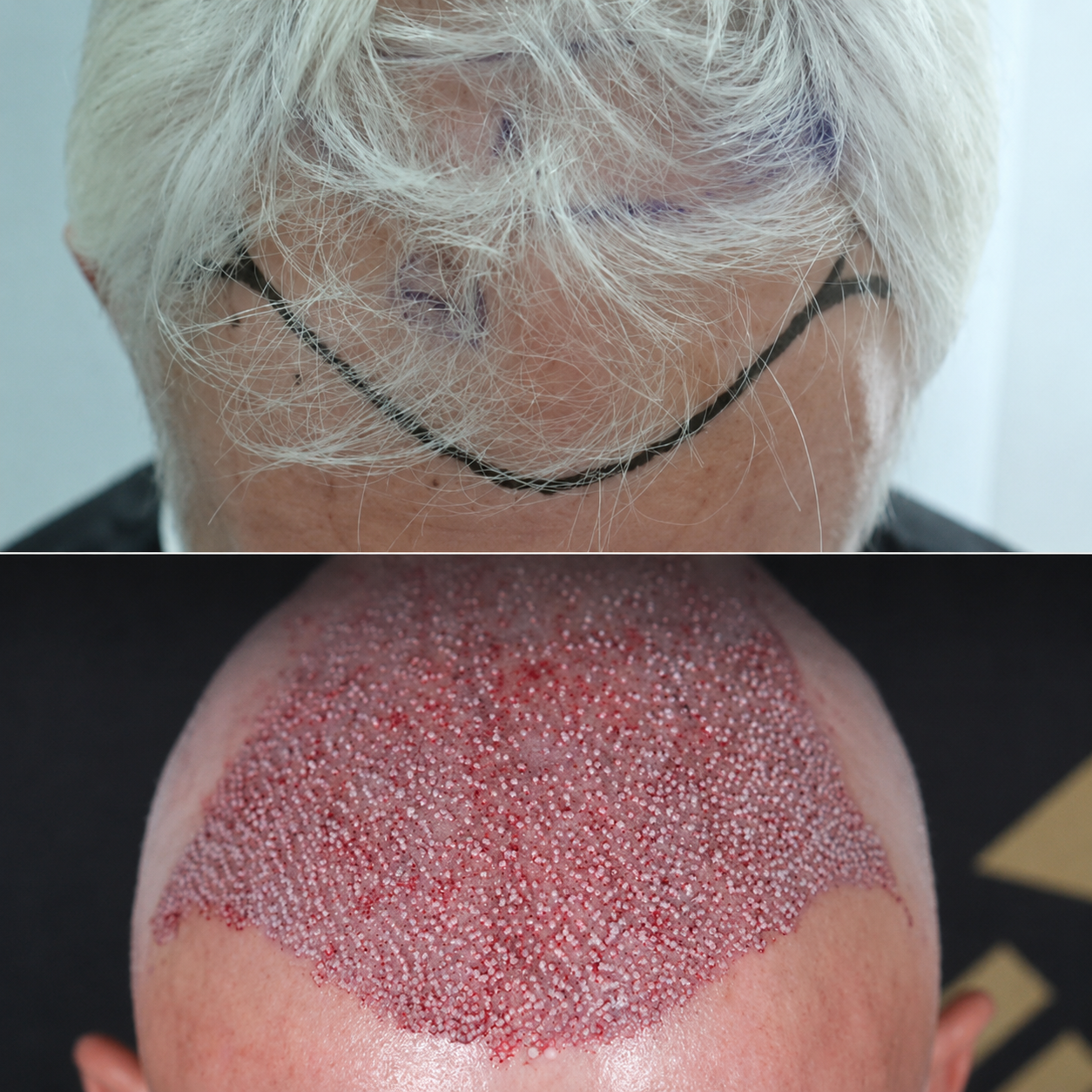 Top photo shows a person with white hair and glasses, viewed from above, with a surgical cap and marks on the forehead. Bottom photo shows a person's shaved scalp with small, evenly spaced dots or markings, likely from a medical or cosmetic procedure.