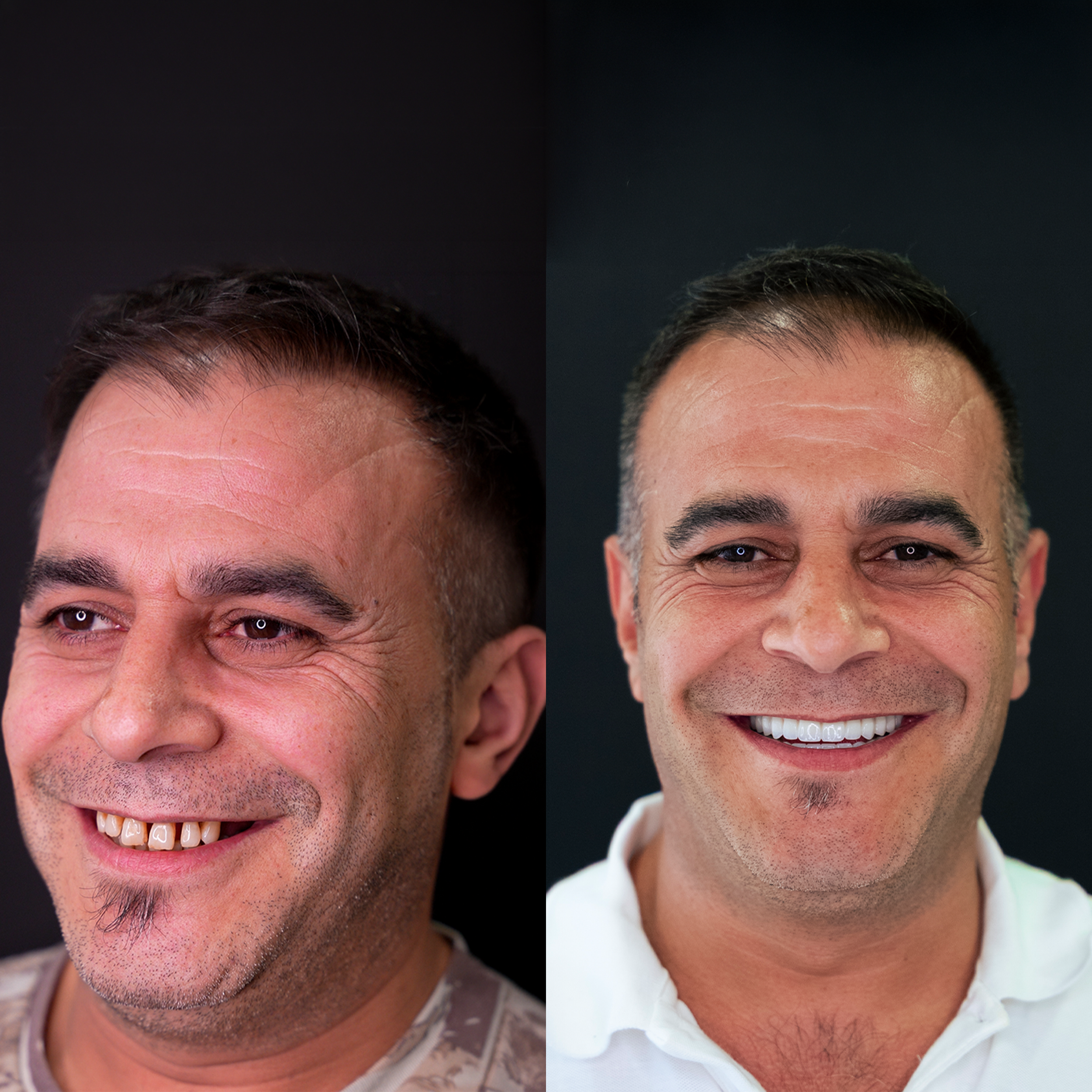Comparison of two men's faces before and after hair restoration, highlighting improved hair density and appearance.