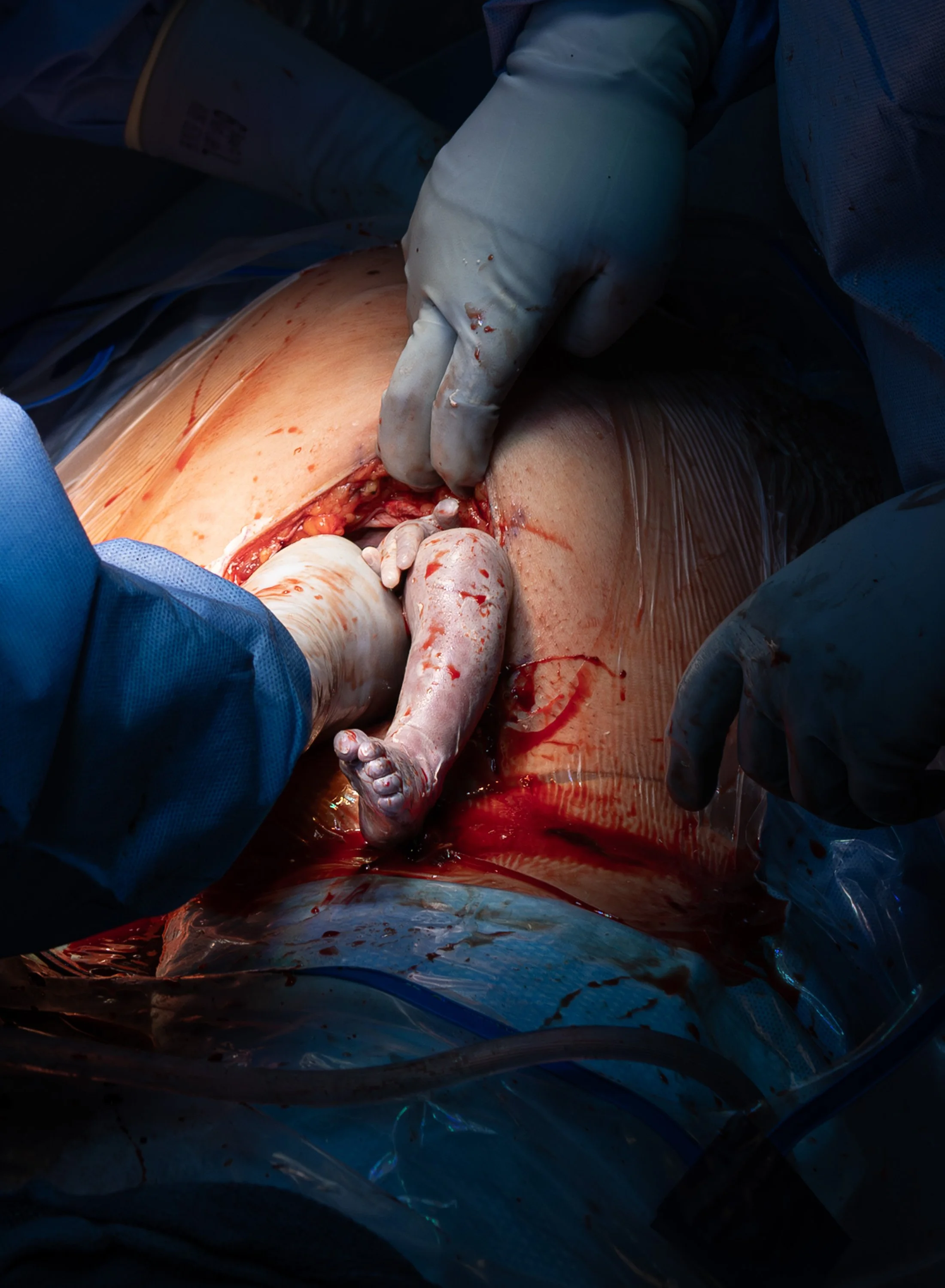 Medical professionals performing surgery with gloved hands and surgical instruments on a patient. c-section birth photographer in Austin 