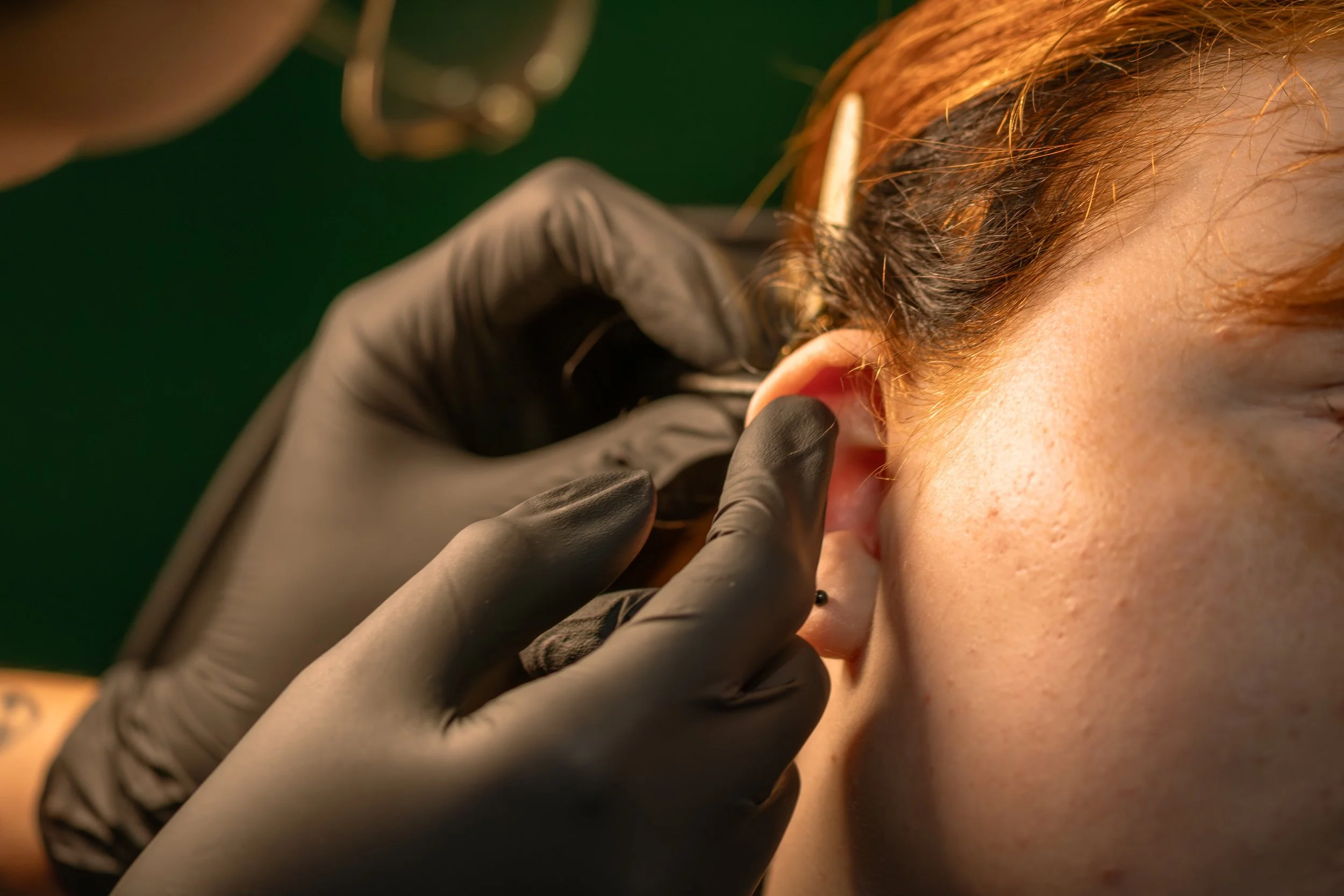 Close-up of a laser tattoo removal procedure on a person's ear with a technician wearing black gloves.
