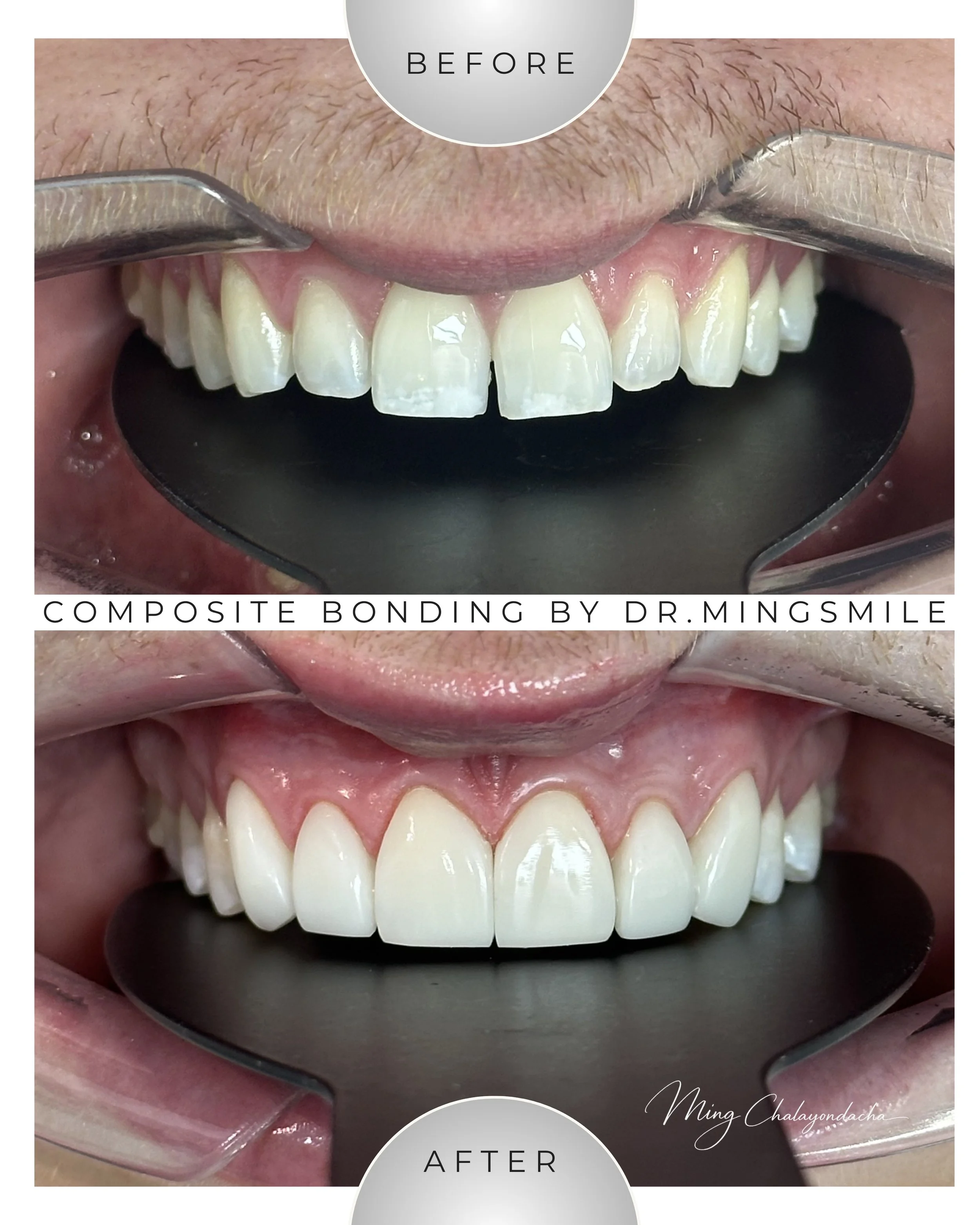Comparison of teeth before and after composite bonding by Dr. Ming Smile showing improved appearance.