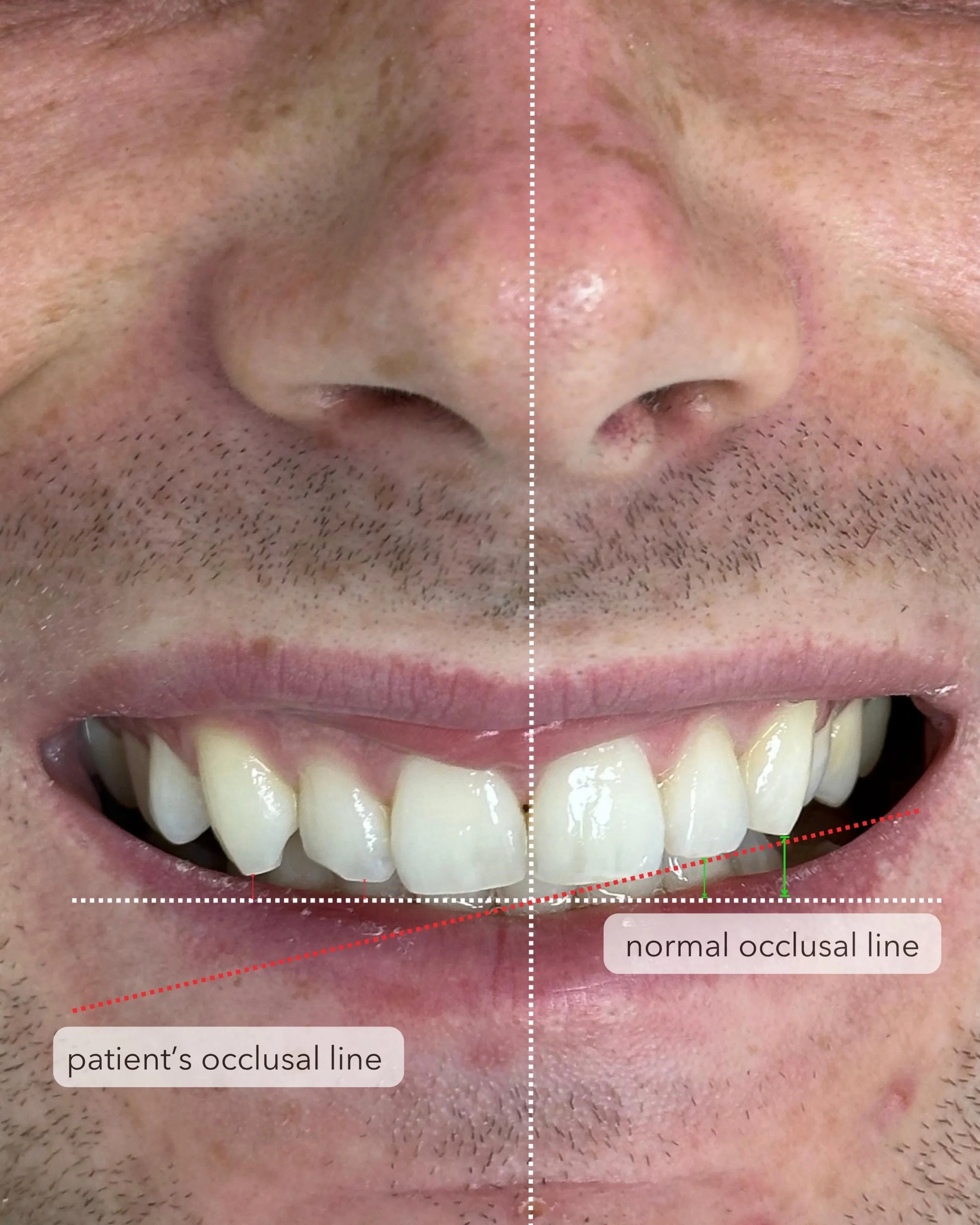 Close-up of a person's smiling face showing their nose, upper teeth, and part of their chin. The image is divided into two halves with markings indicating the patient's occlusal line and the normal occlusal line for comparison.