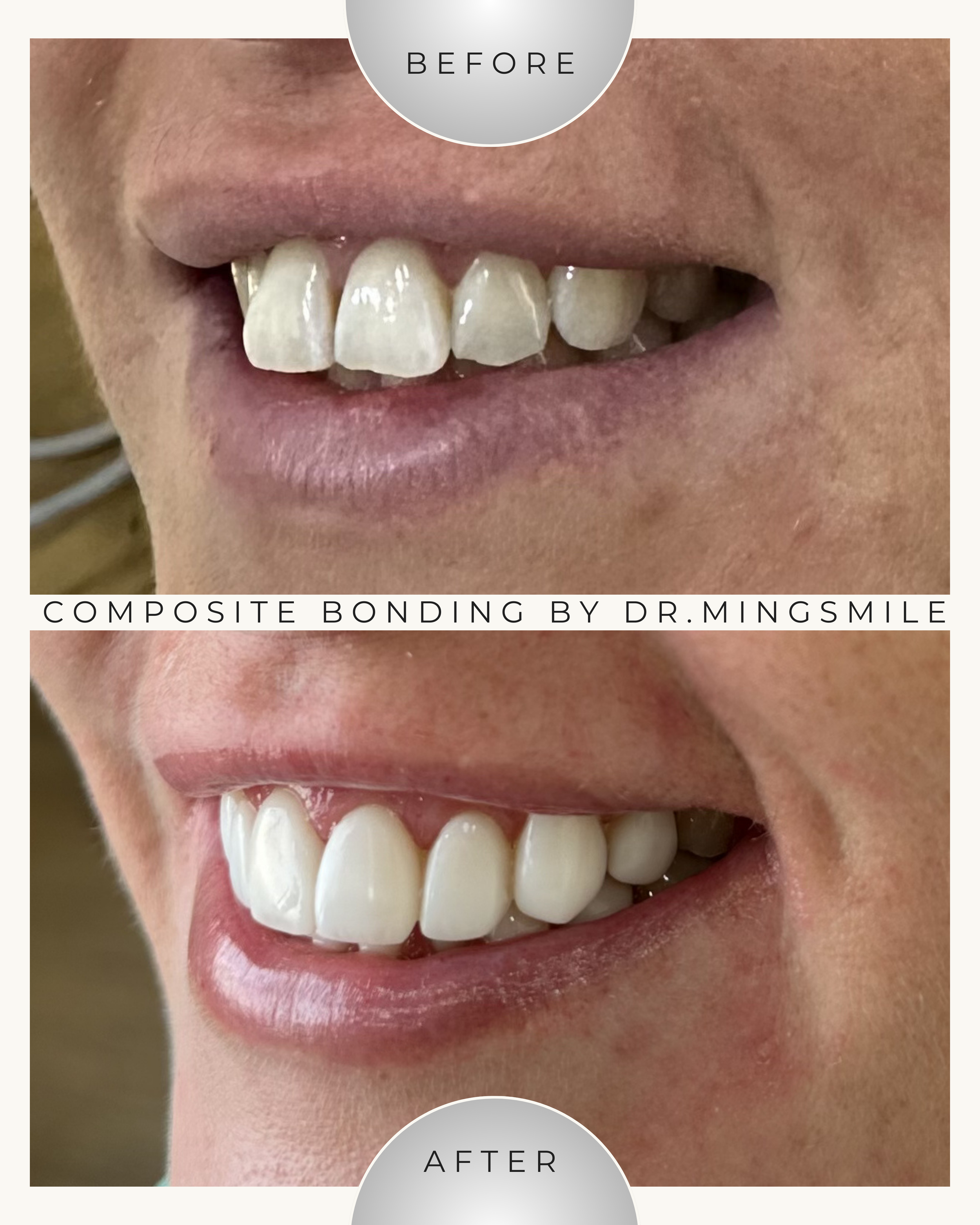 Close-up of a person's smile showing white, straight teeth before and after composite bonding procedure.