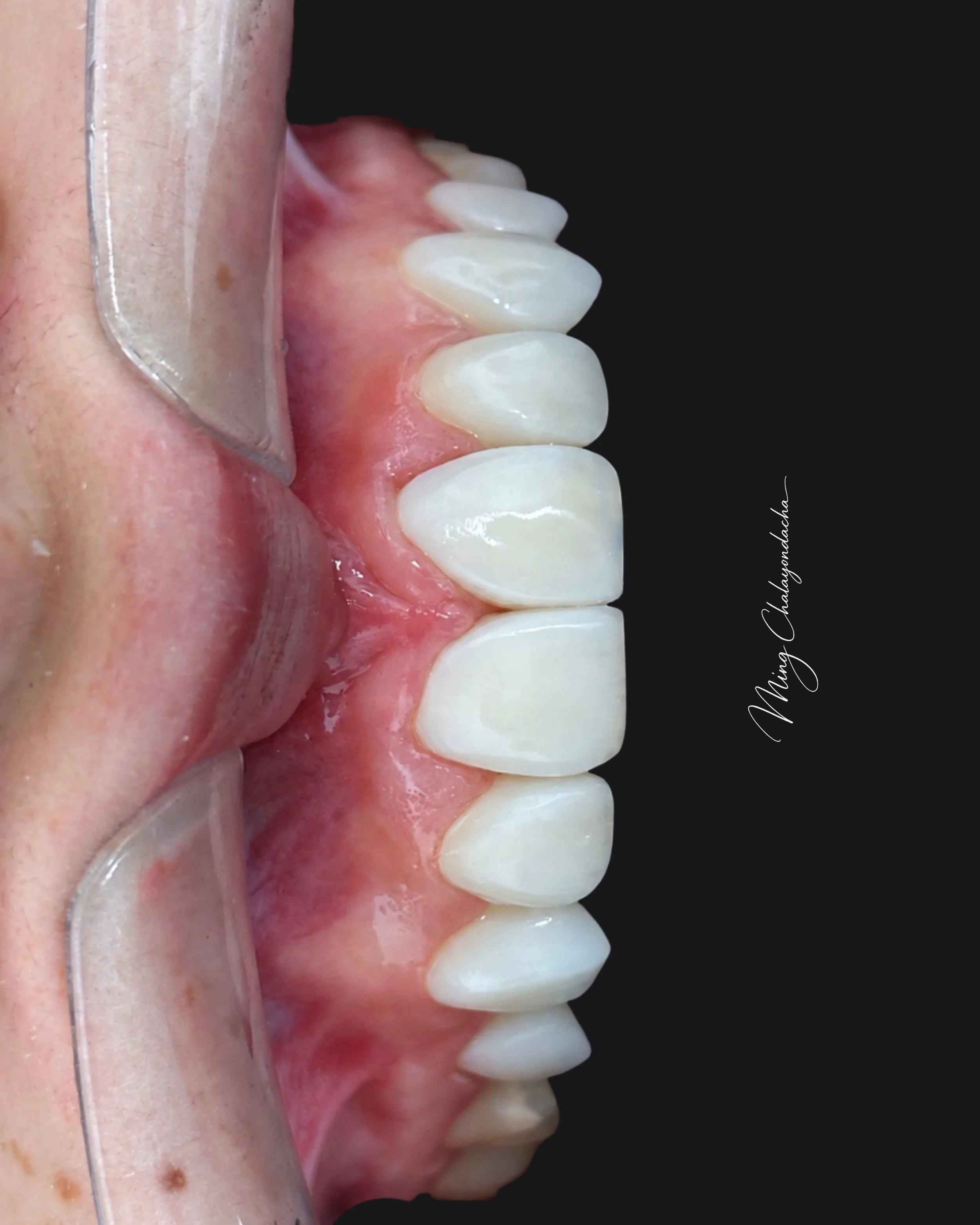Close-up of a set of upper teeth and gum tissue with a clear orthodontic retainer covering the teeth.