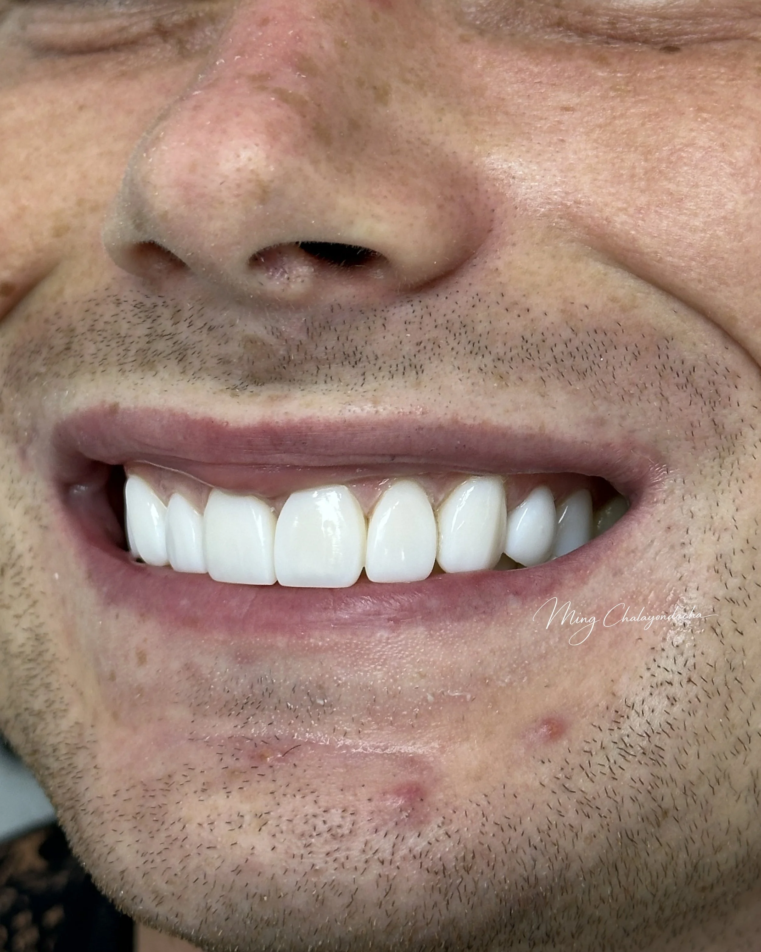 A close-up of a person's face showing a broad smile with teeth visible, focusing on the nose, mouth, and some facial hair.