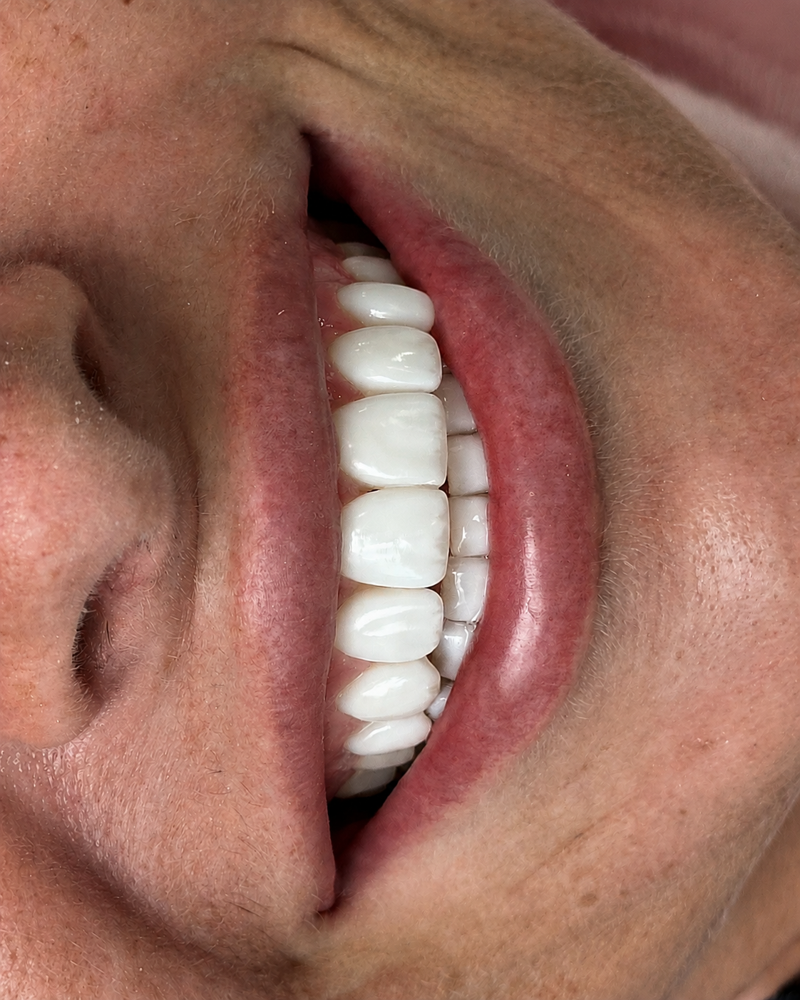 Close-up of a person's open mouth showing white teeth and lips.