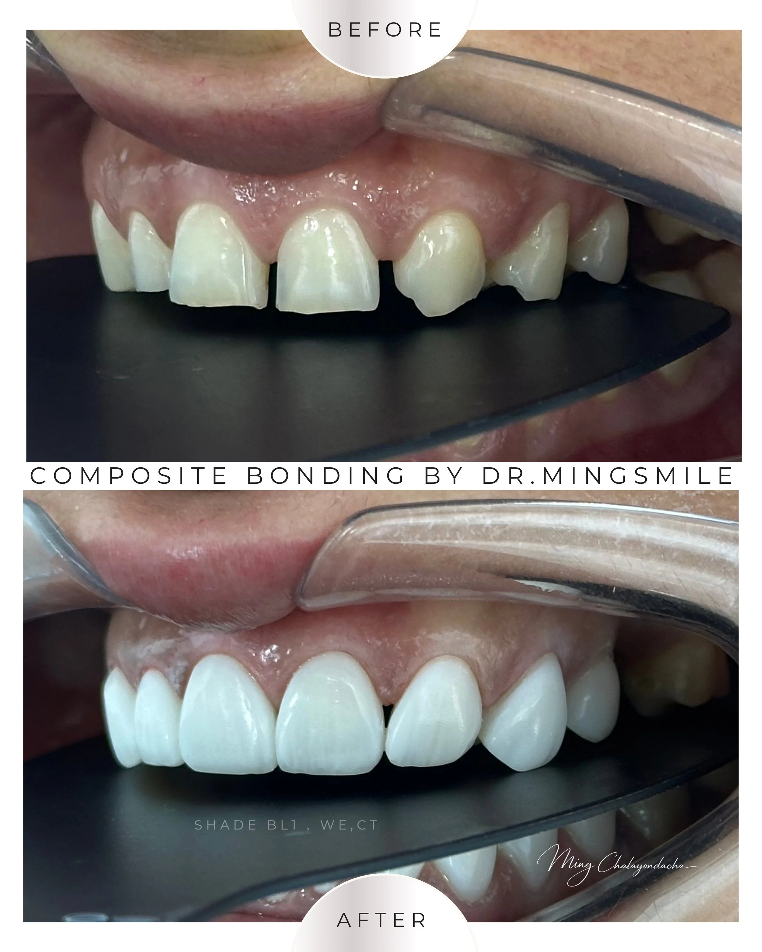 composite bonding  thailand bangkok krabi