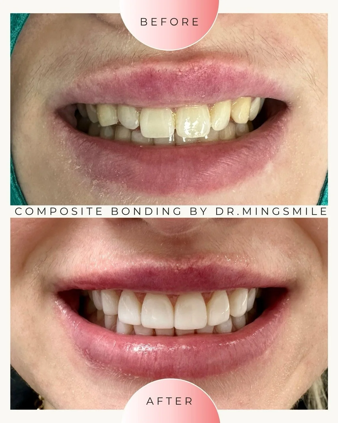 Comparison of teeth before and after composite bonding, showing improved alignment and color matching.