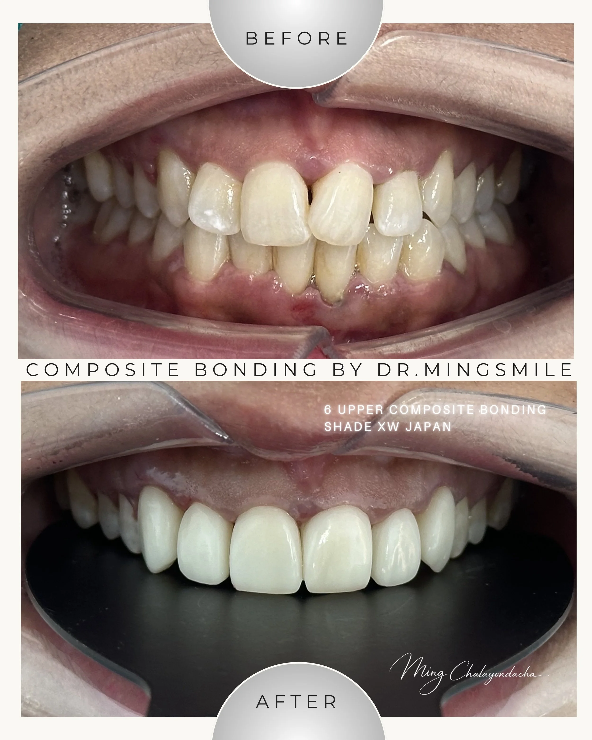 Close-up of a person's teeth showing before and after composite bonding by Dr. Mingsmile, with the upper teeth treated for cosmetic improvement and the lower teeth untreated for comparison.