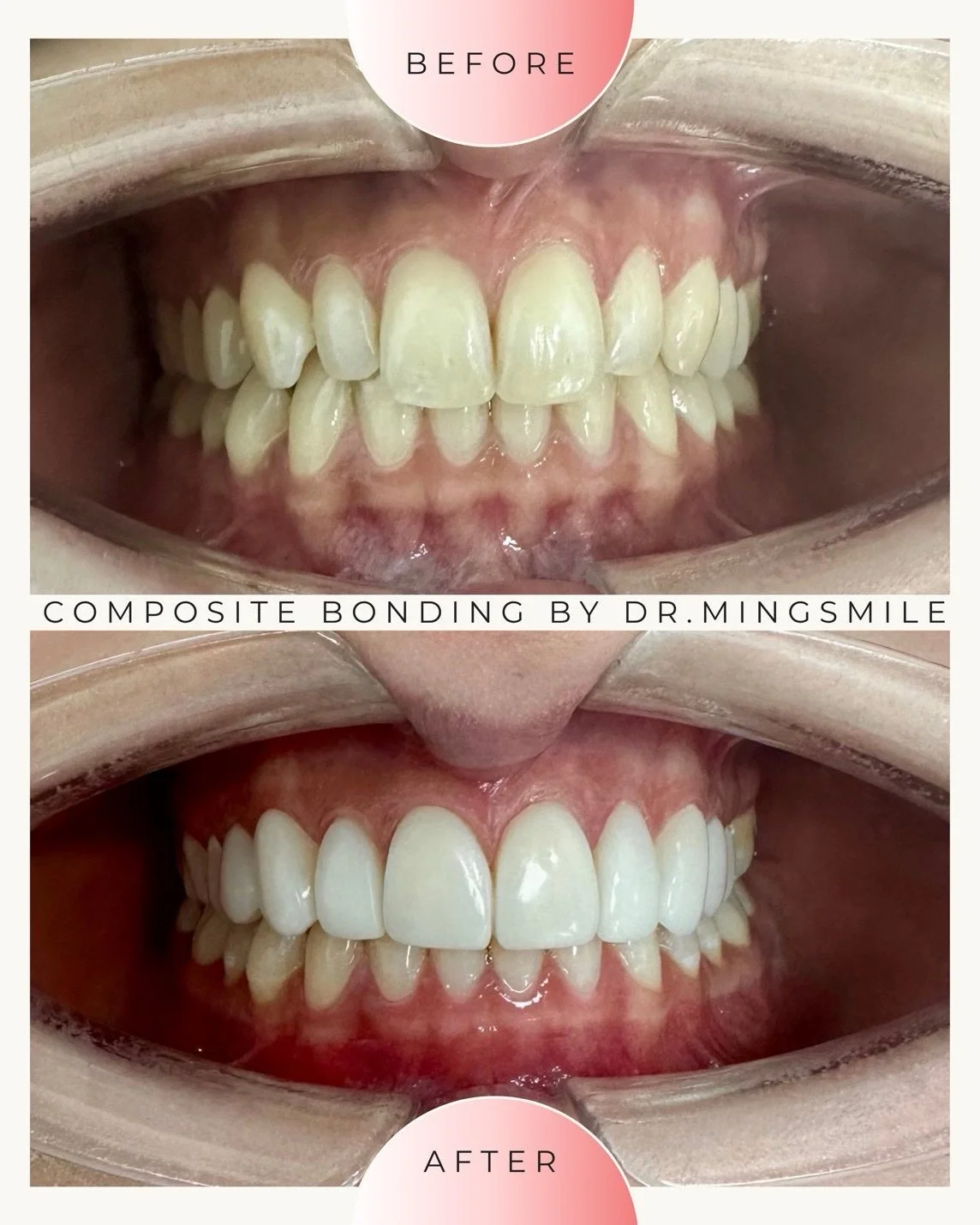 Comparison of teeth before and after composite bonding, showing improved appearance after dental work by Dr. Mingsmile.