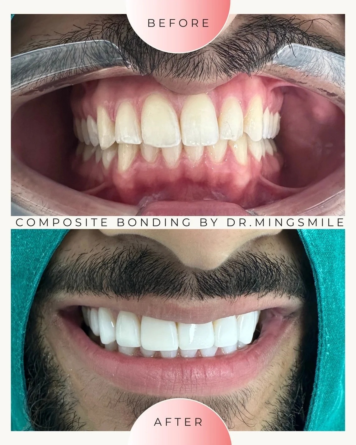 Comparison of teeth before and after composite bonding by Dr. Mingsmile, showing improved dental appearance with straighter, whiter teeth.