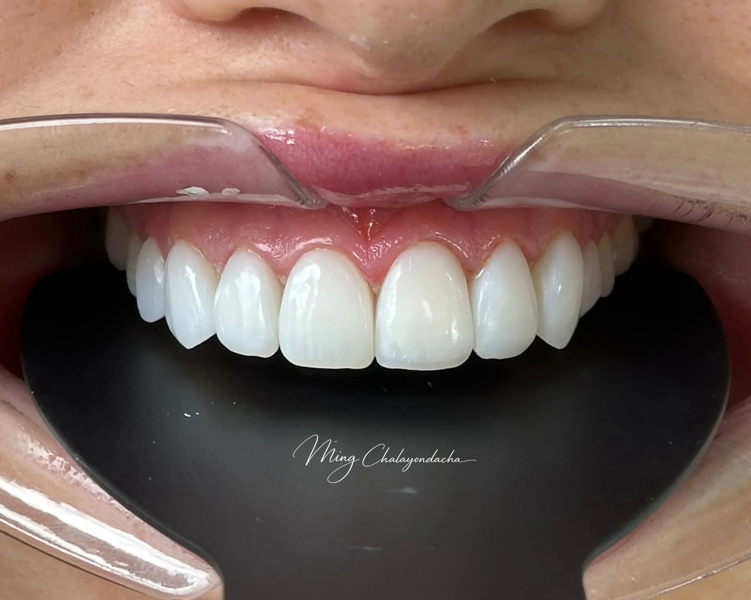 Close-up of a person's smiling mouth with visible upper teeth, wearing a clear dental mouthguard.