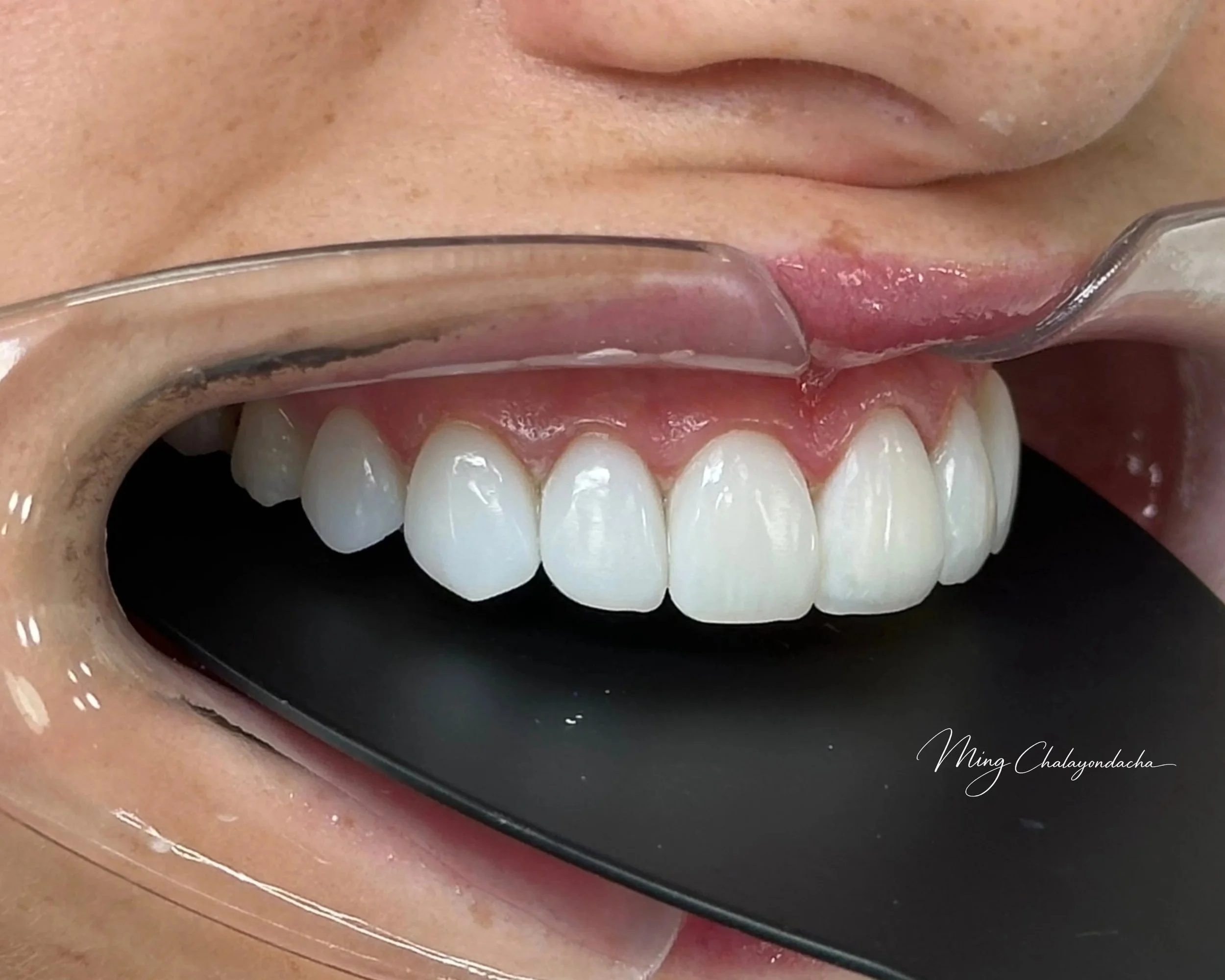 Close-up of a person's mouth with a dental mirror reflecting teeth and gums, showing the inside of the mouth with clear teeth, pink gums, and the dental mirror.