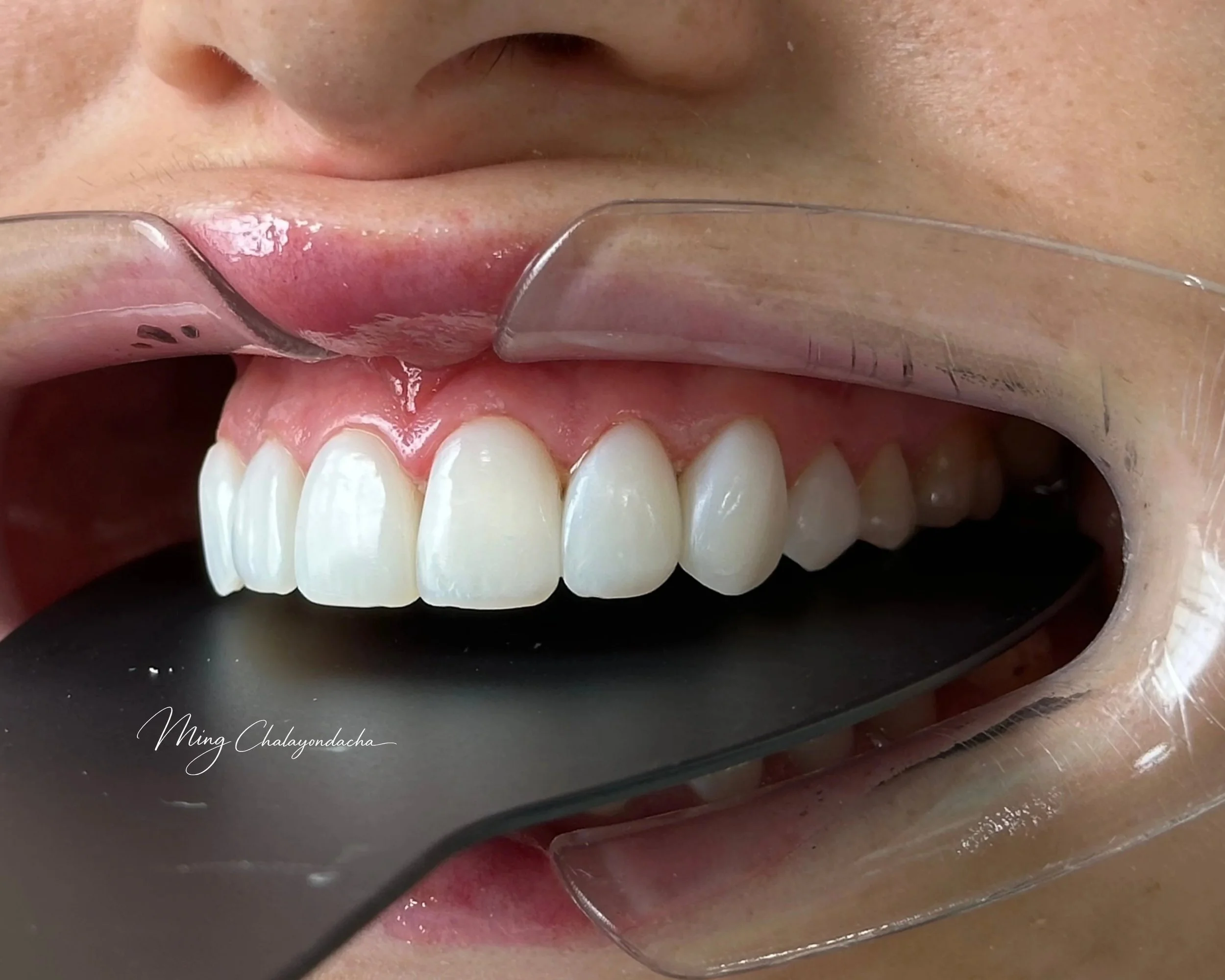 Close-up of a person’s mouth showing white teeth, pink gums, and pink lips, with a dental mirror reflecting part of the mouth and a dental instrument nearby.